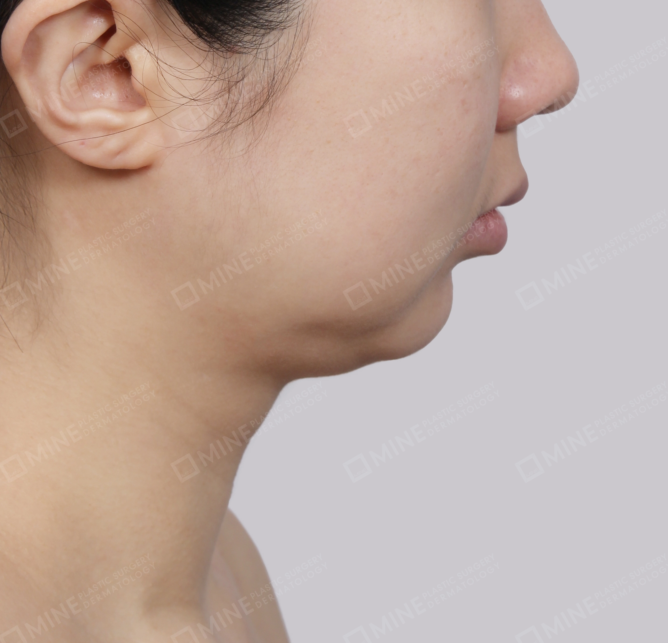 Căng da cổ Mini-측면-전