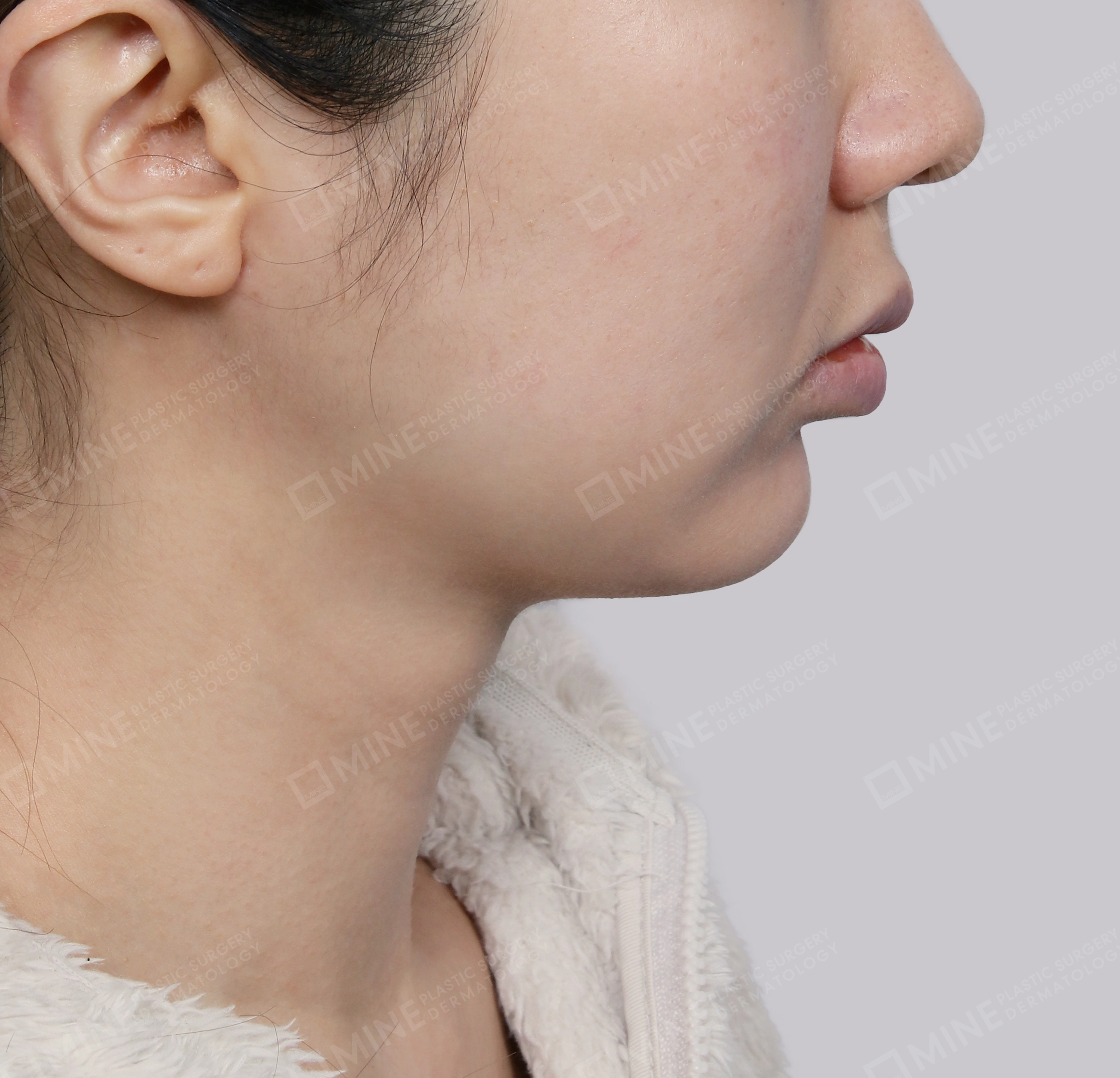 Căng da cổ Mini-측면-후