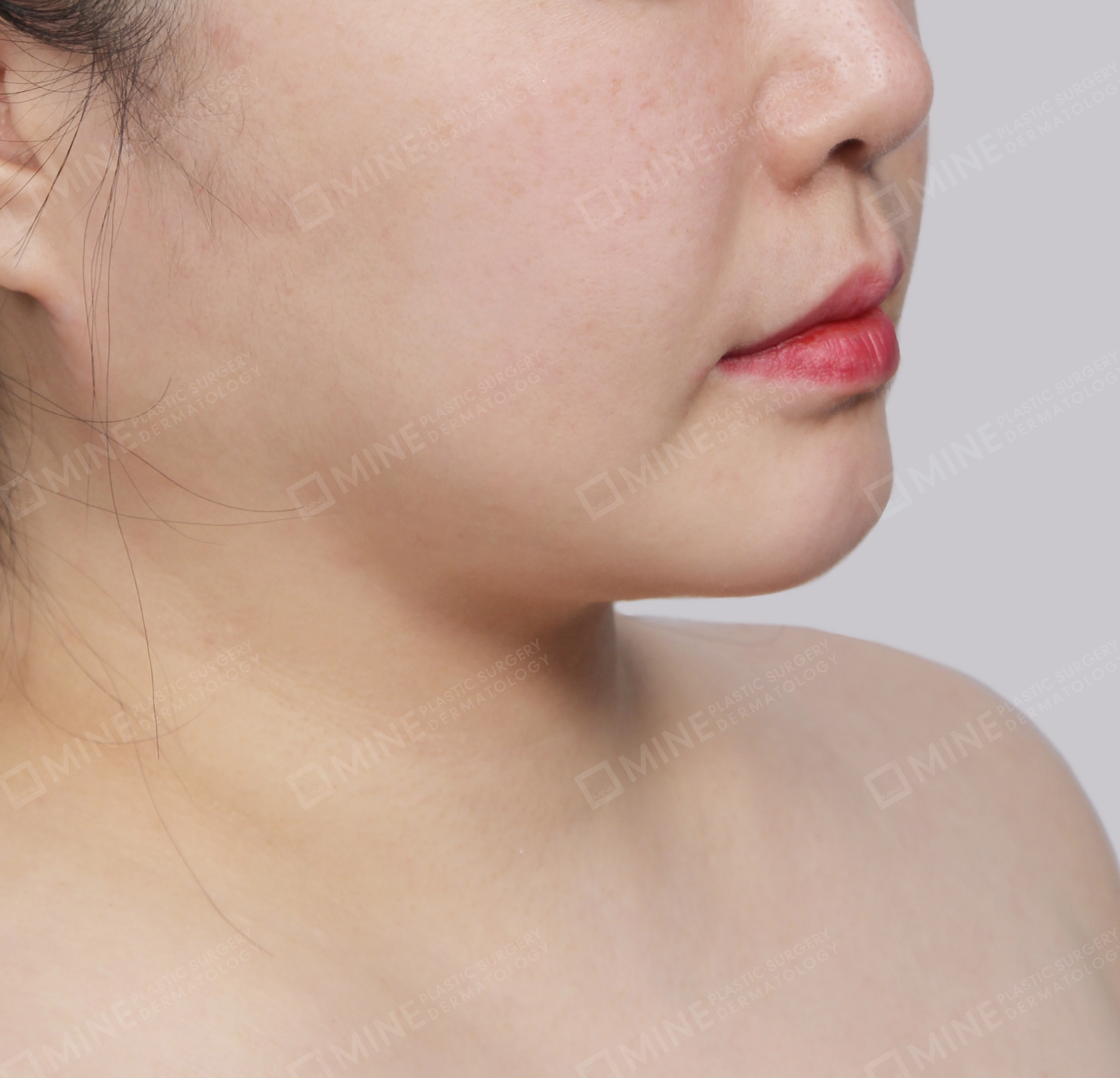 Căng da cổ Mini-정면-전