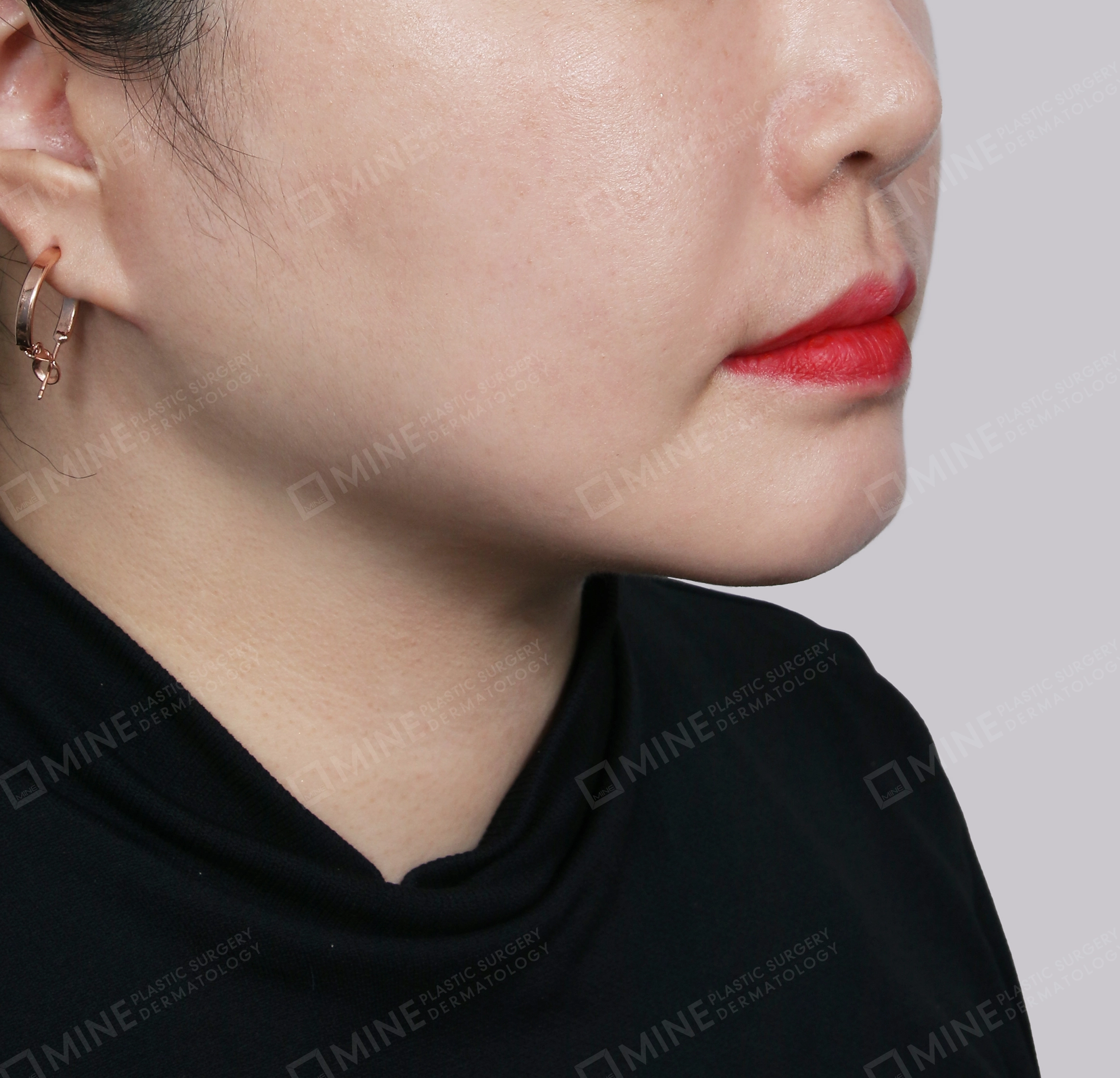 Căng da cổ Mini-정면-후