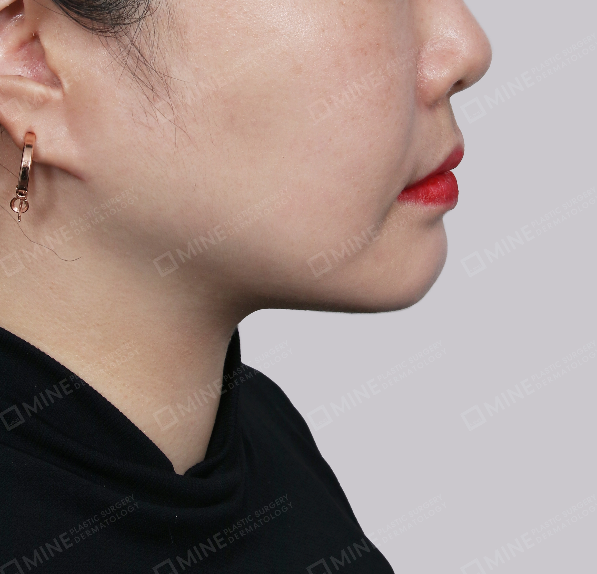 Căng da cổ Mini-측면-후