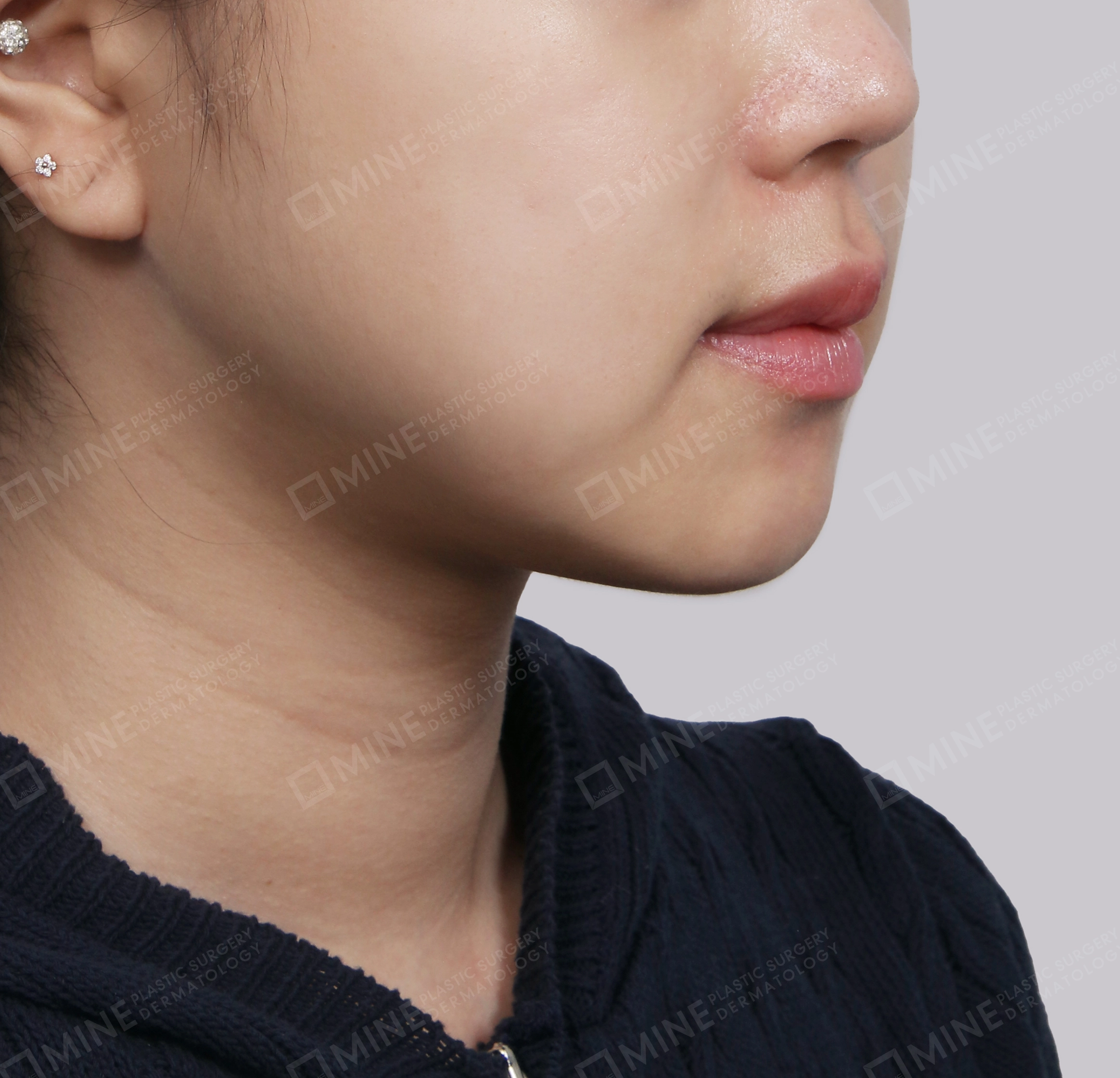 Căng da cổ Mini-정면-후