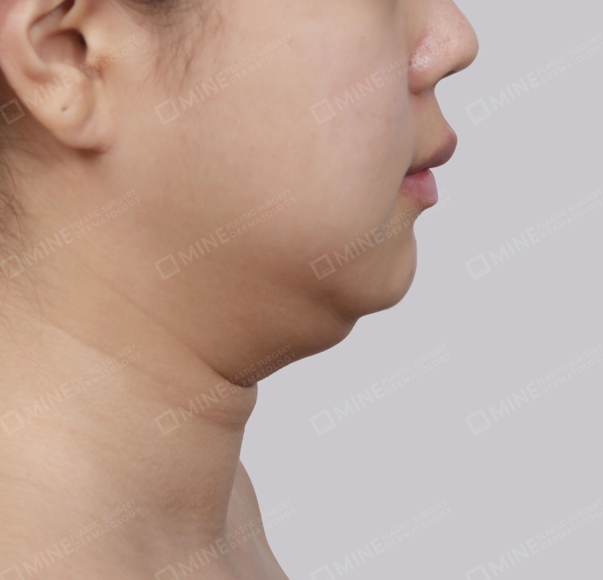 Căng da cổ Mini-측면-전