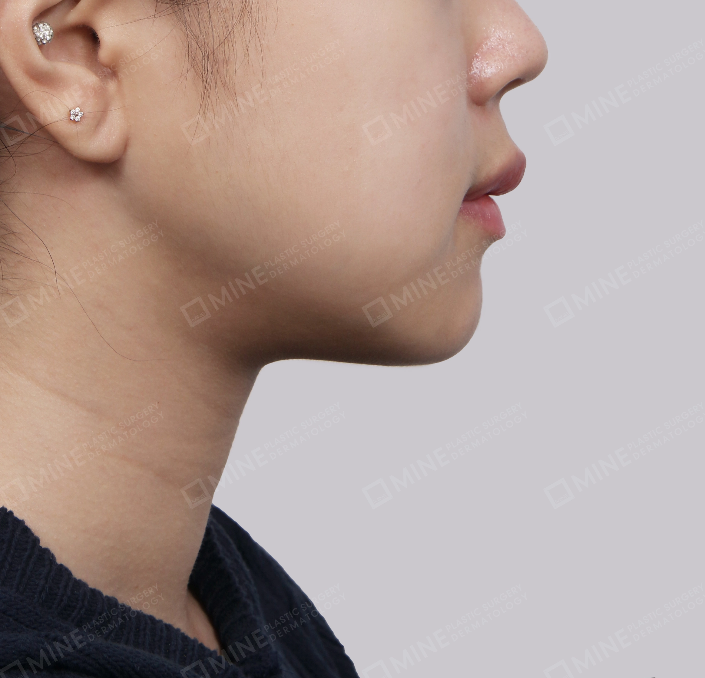 Căng da cổ Mini-측면-후