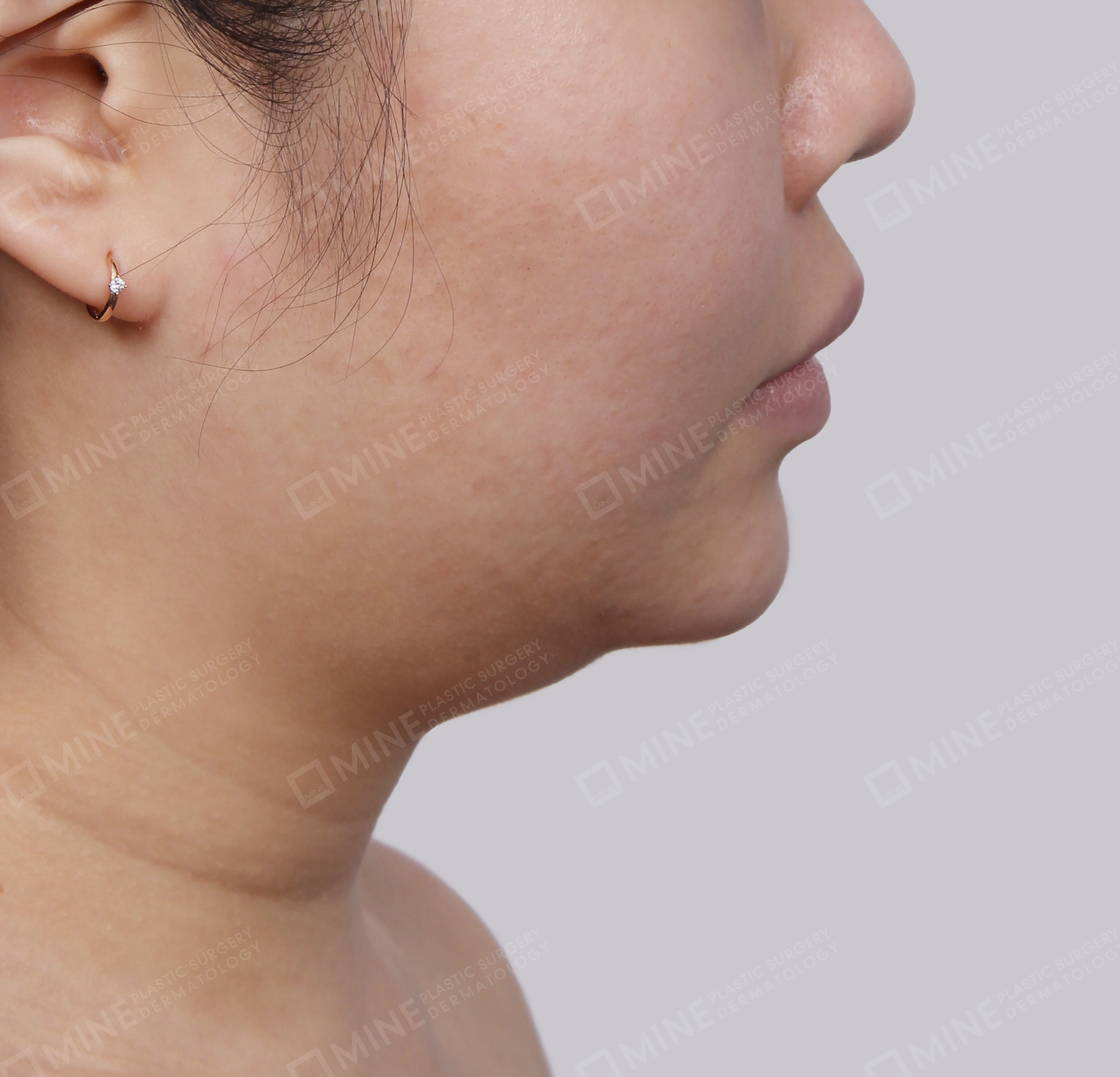 Căng da cổ Mini-측면-전