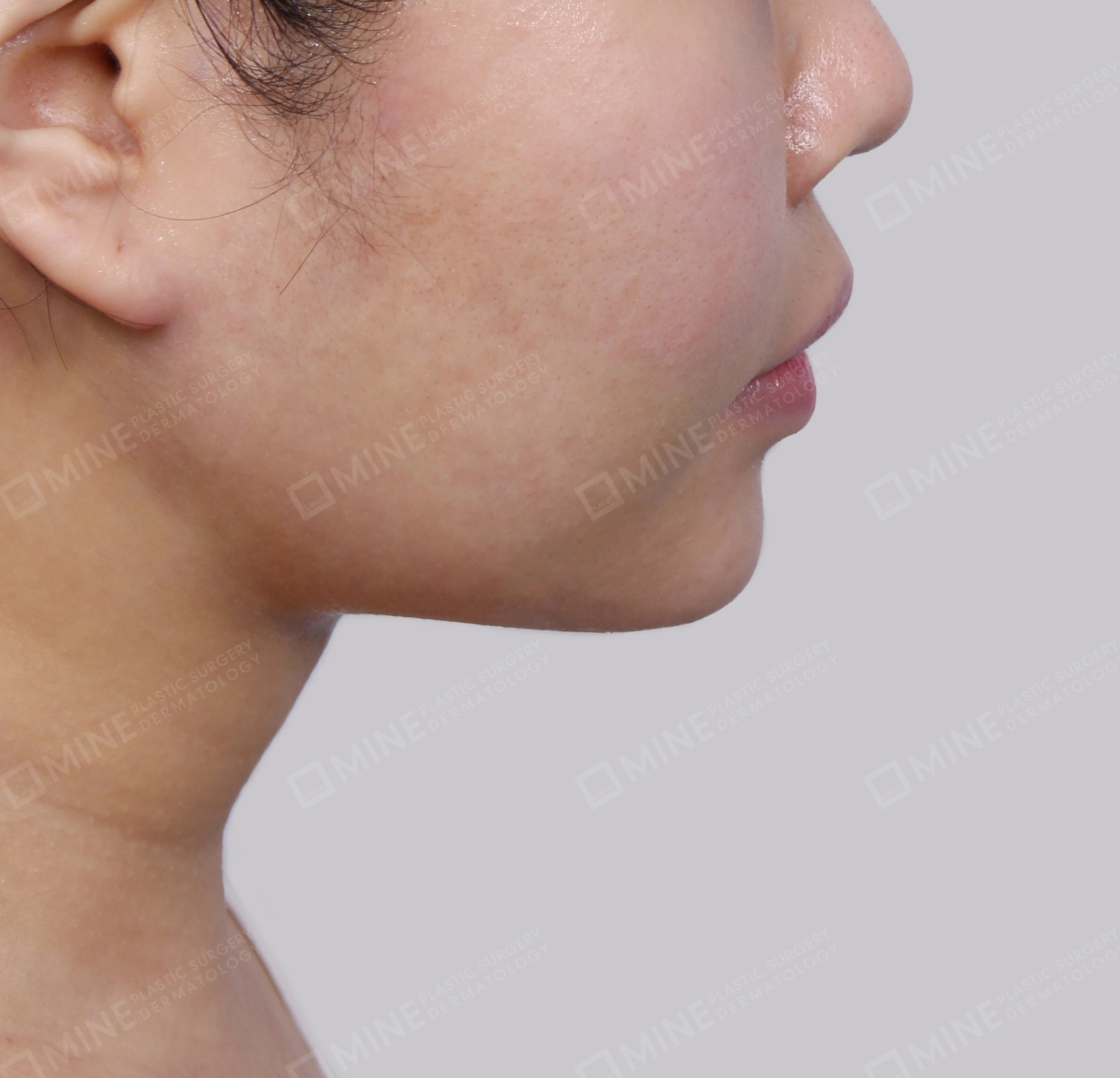 Căng da cổ Mini-측면-후