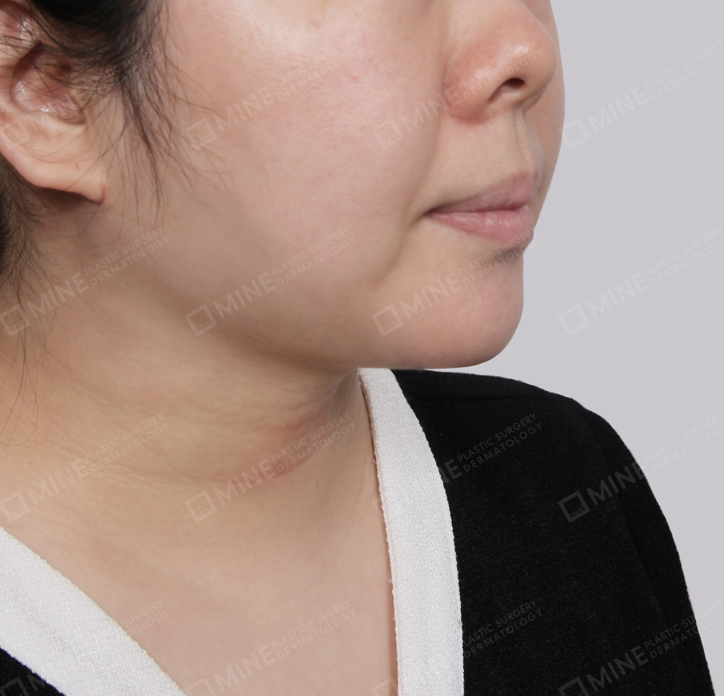 Căng da cổ Mini-정면-후