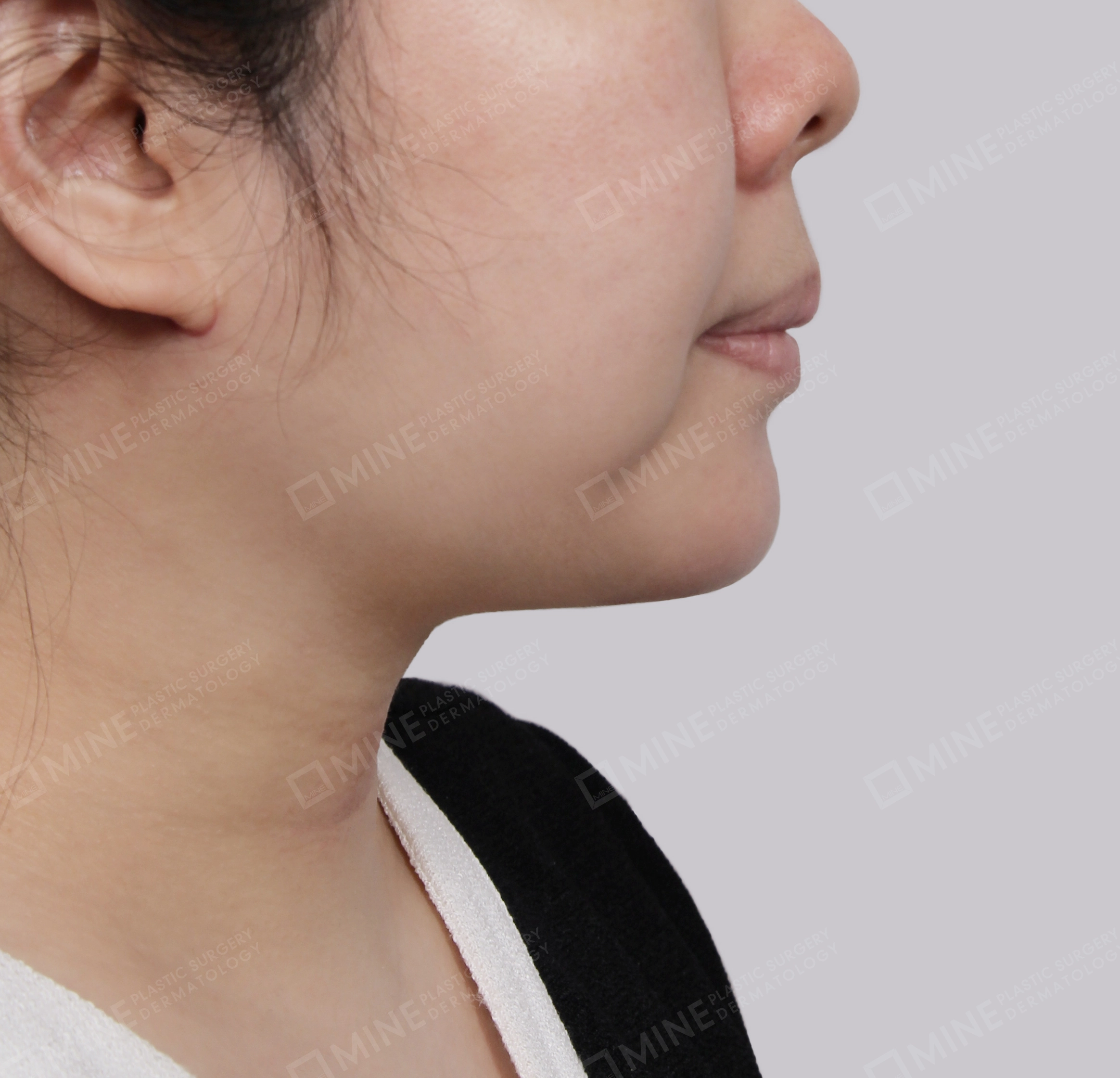 Căng da cổ Mini-측면-후