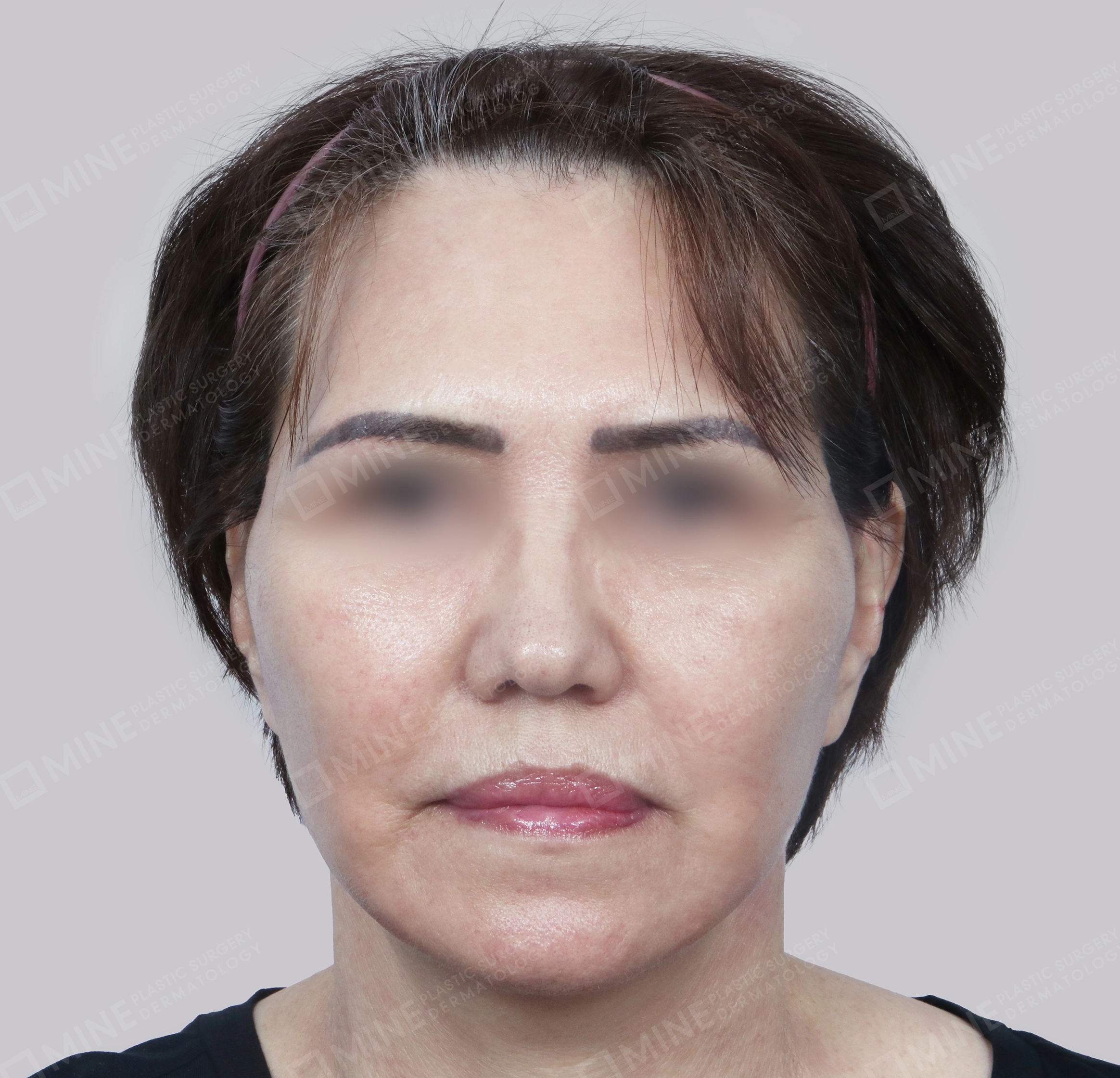 Căng da toàn mặt-정면-후