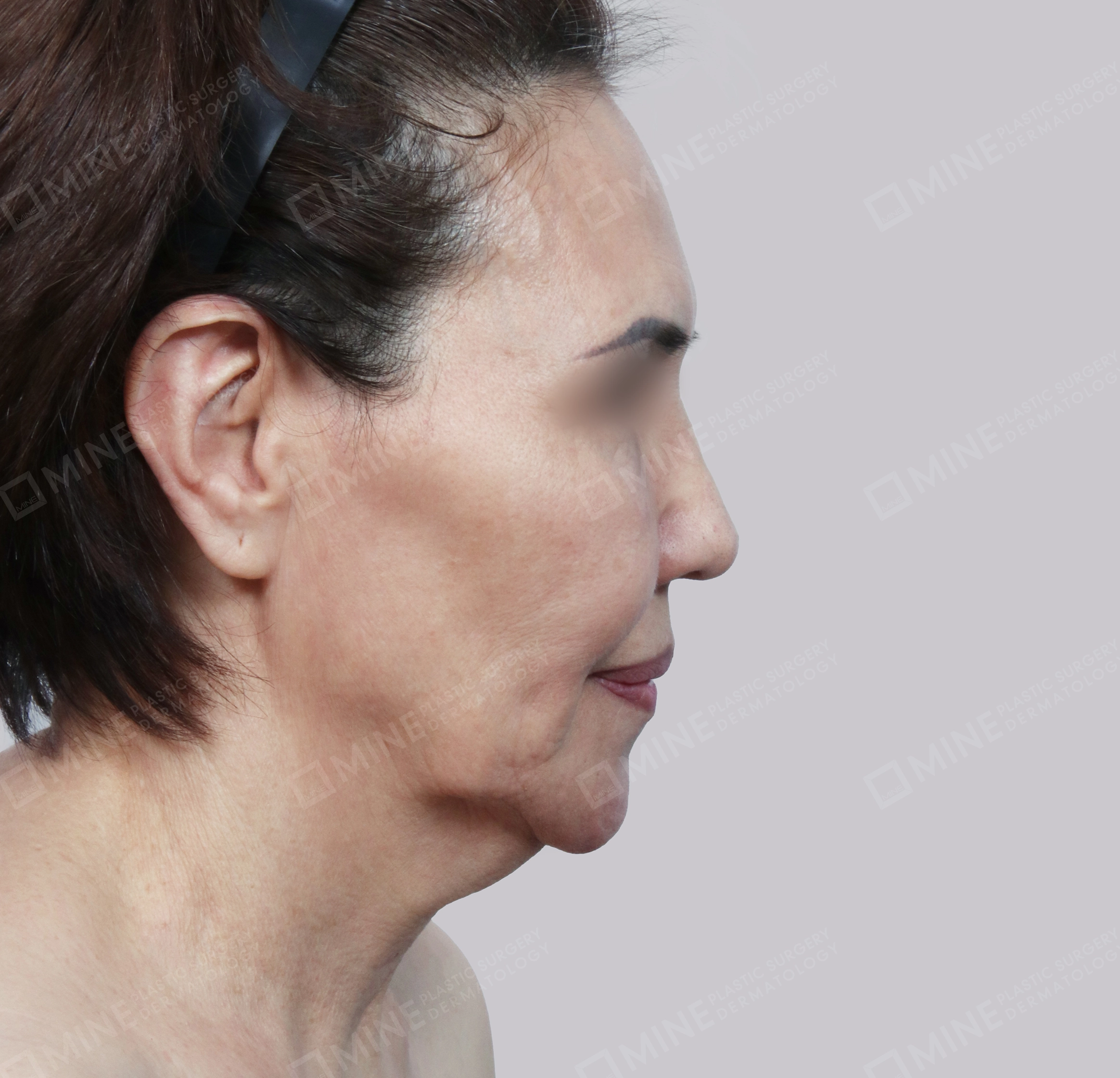 Căng da toàn mặt-측면-전