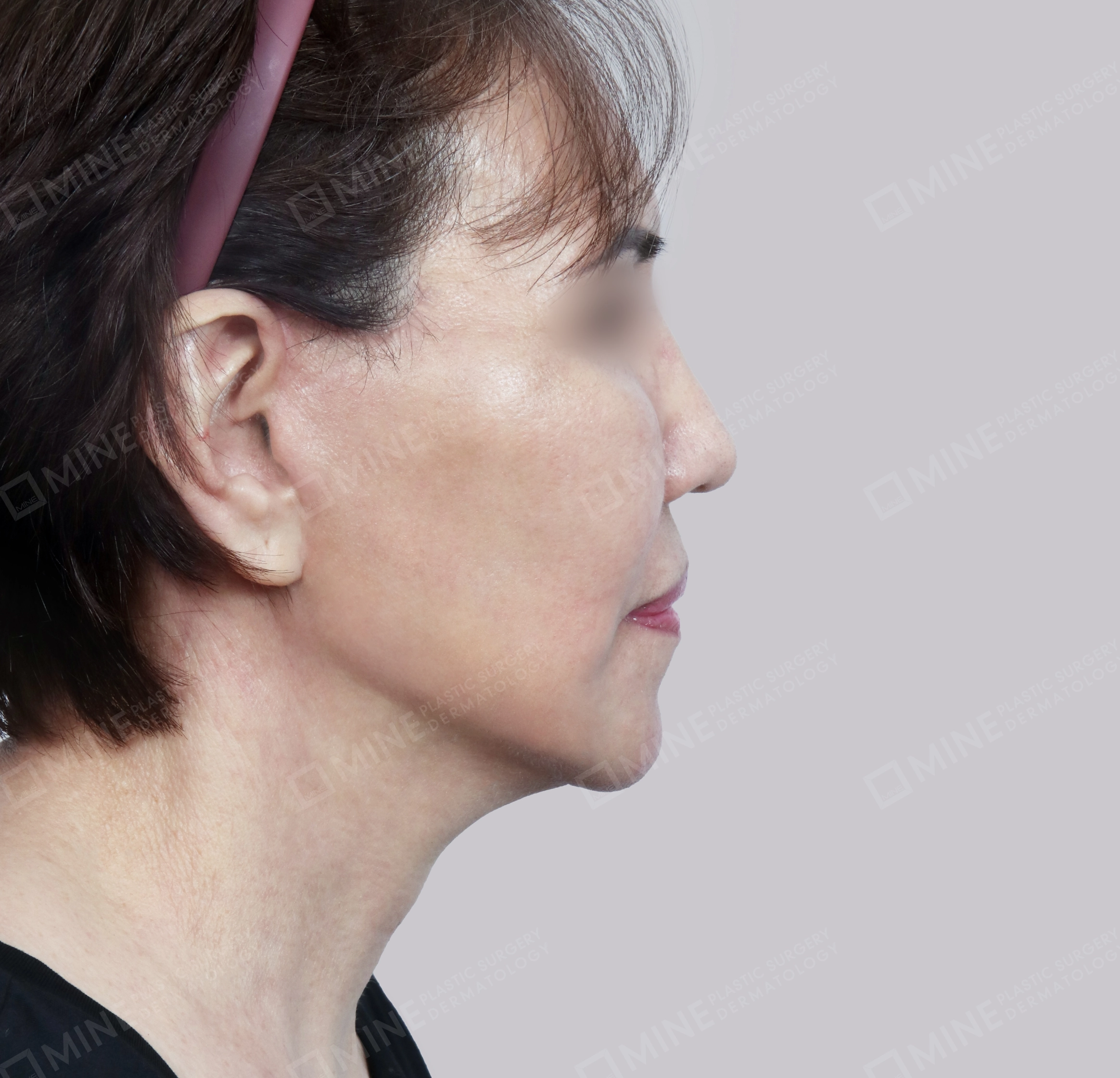 Căng da toàn mặt-측면-후