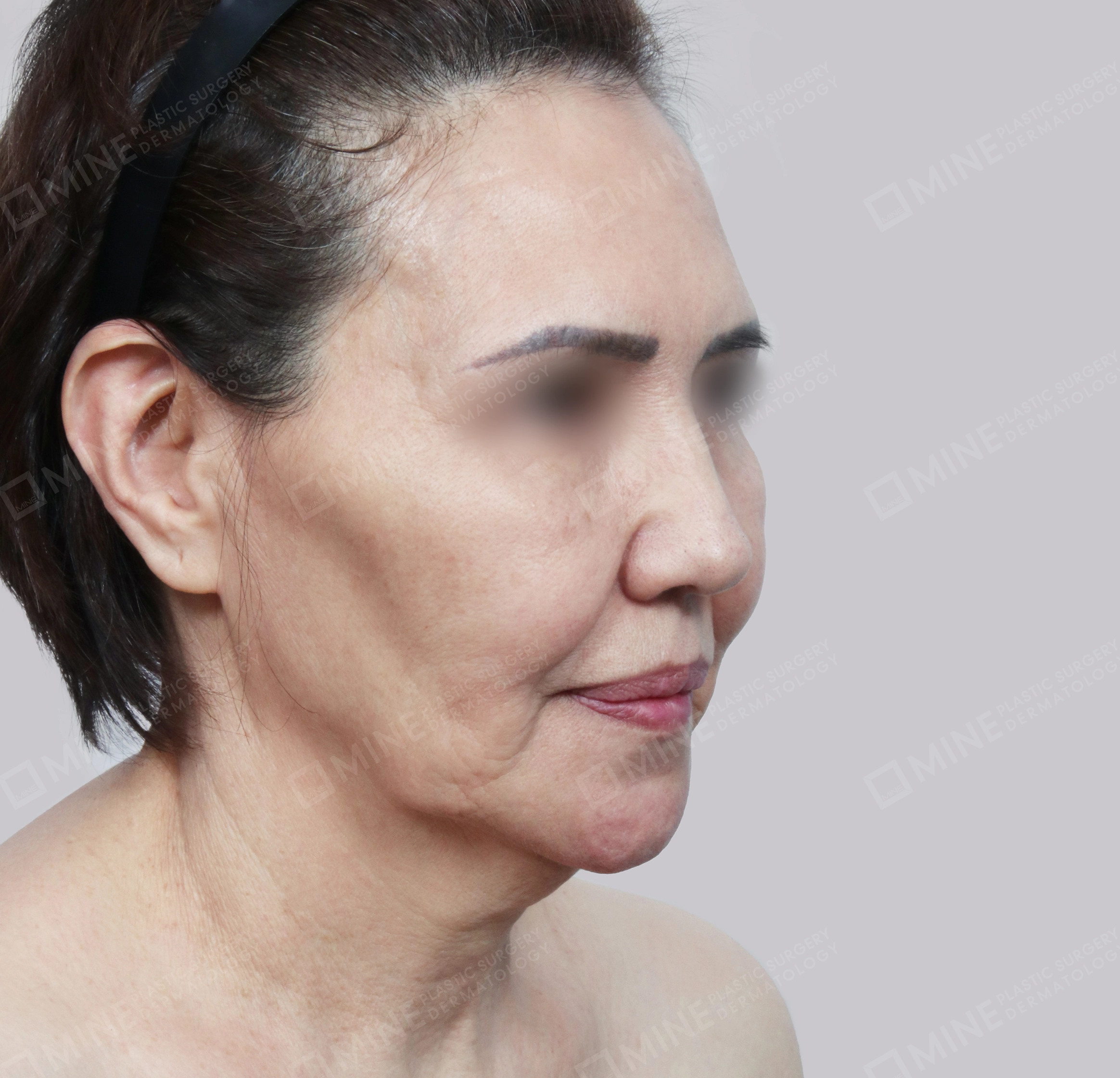 Căng da toàn mặt-45도-전