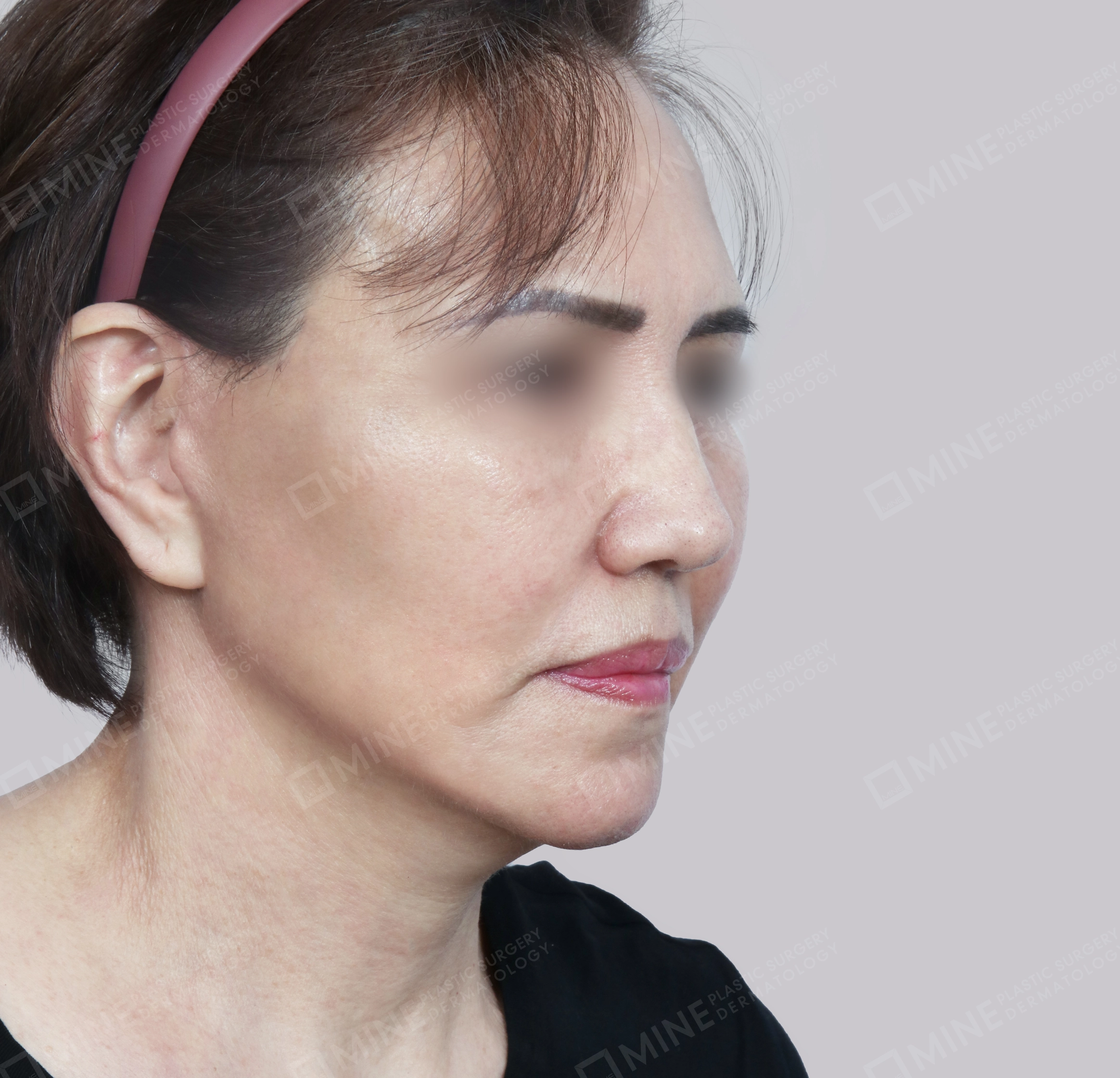 Căng da toàn mặt-45도-후