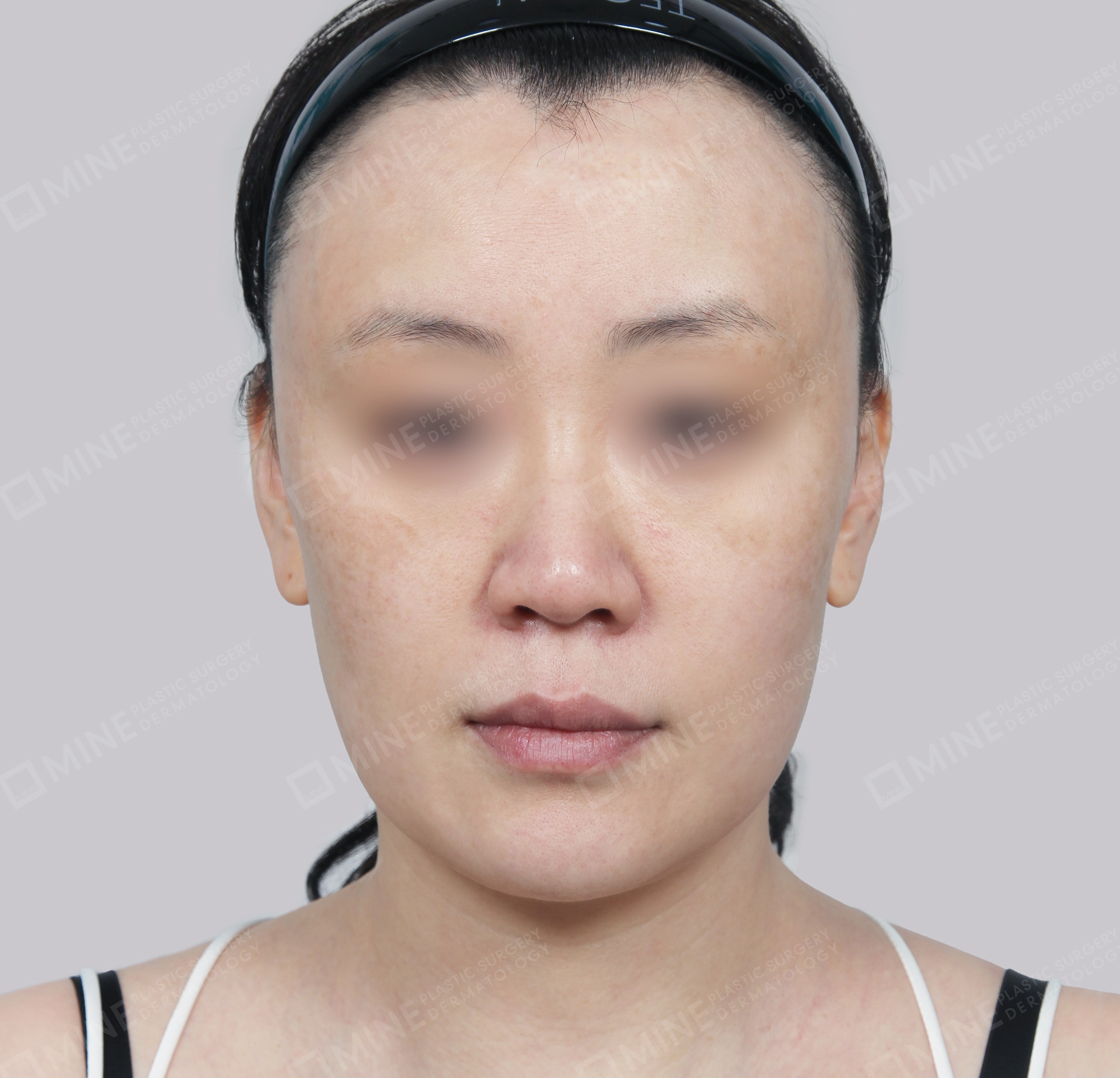 Căng da toàn mặt-정면-전