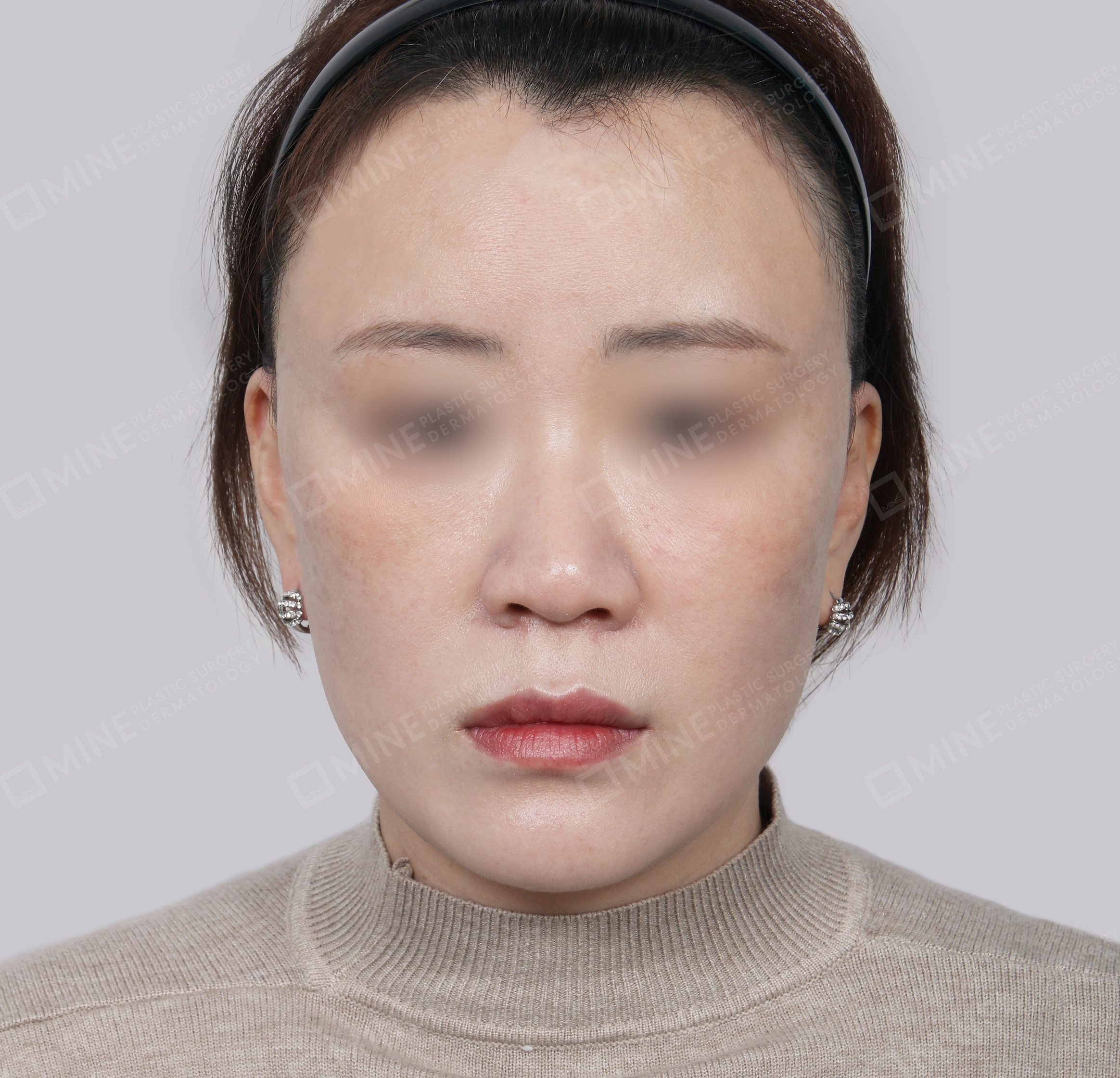 Căng da toàn mặt-정면-후