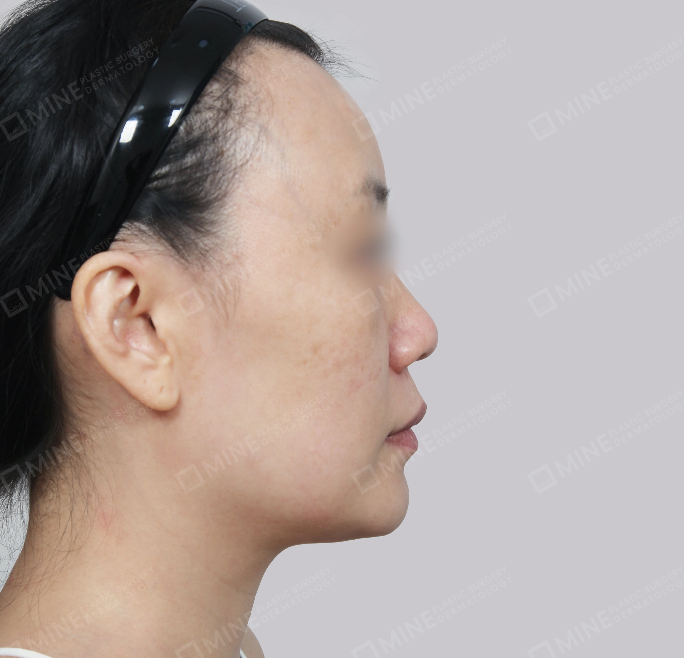 Căng da toàn mặt-측면-전