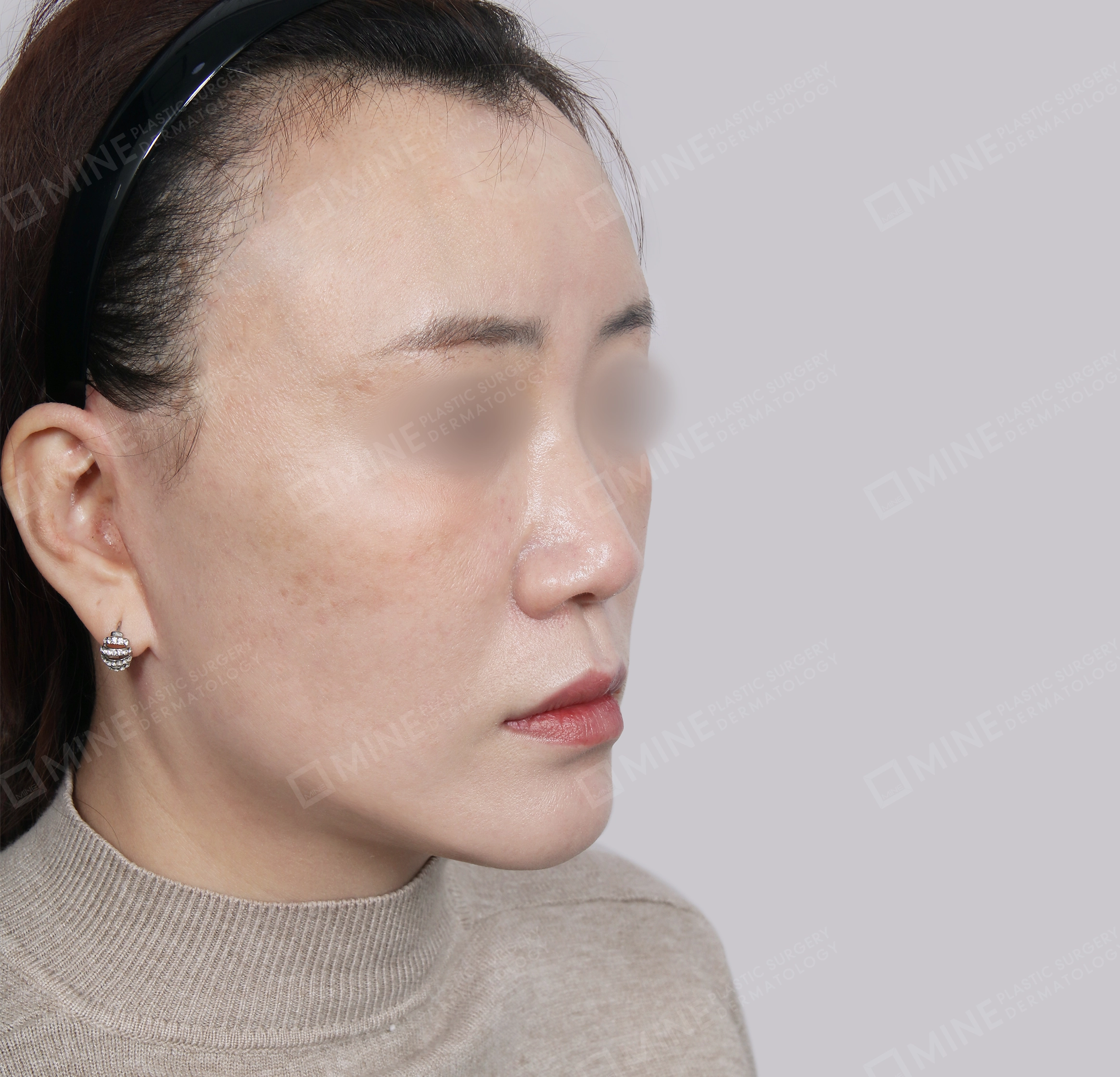 Căng da toàn mặt-45도-후