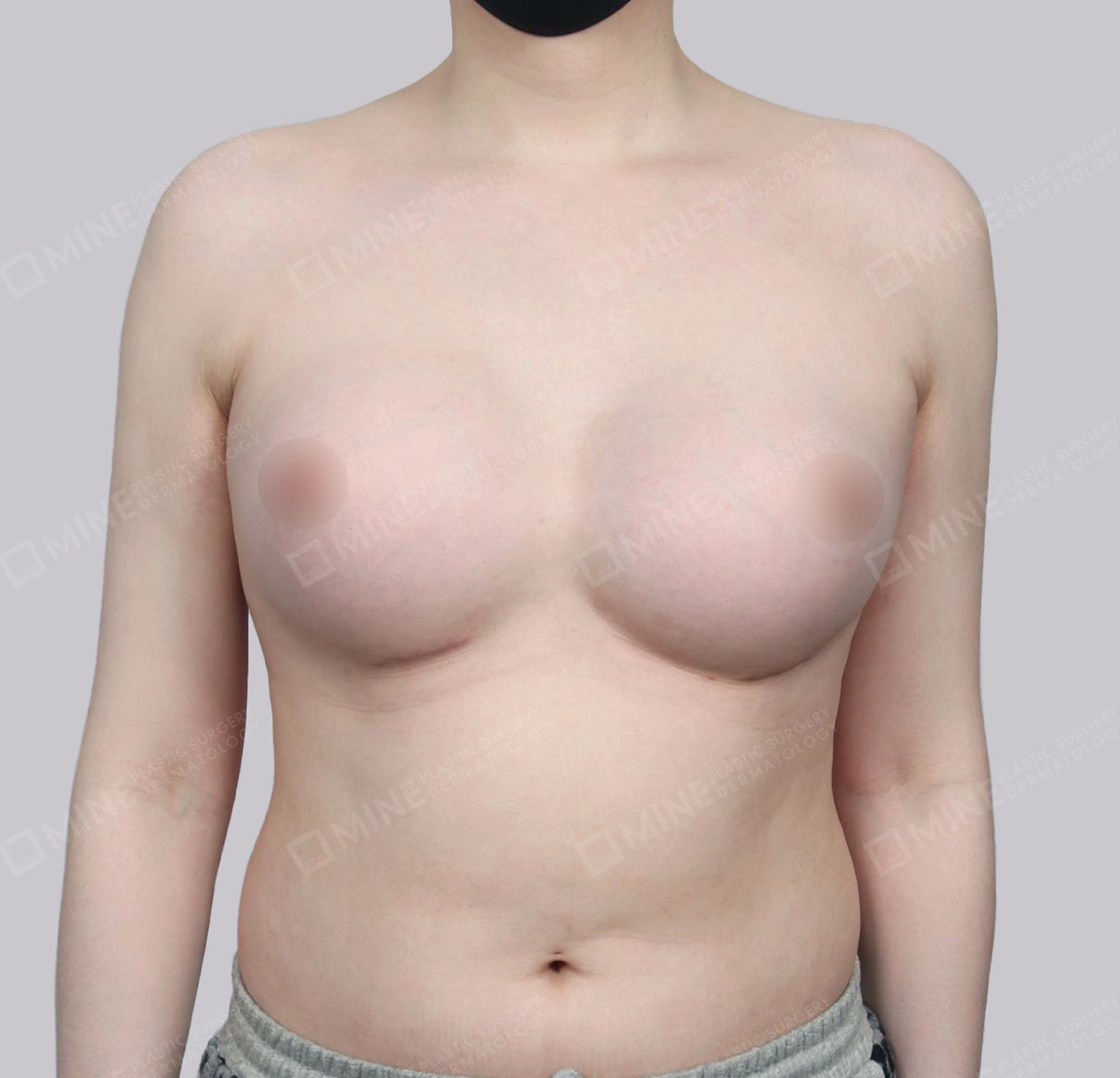 Tái Phẫu Thuật Ngực（Ngực Bị Dính Liền）-정면-전