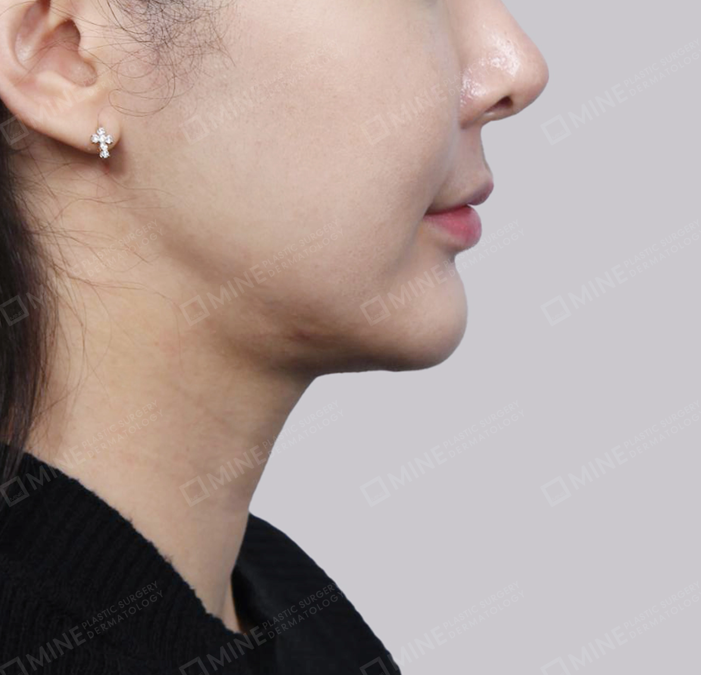 Hút mỡ nọng, cắt tuyến nước bọt-정면-전