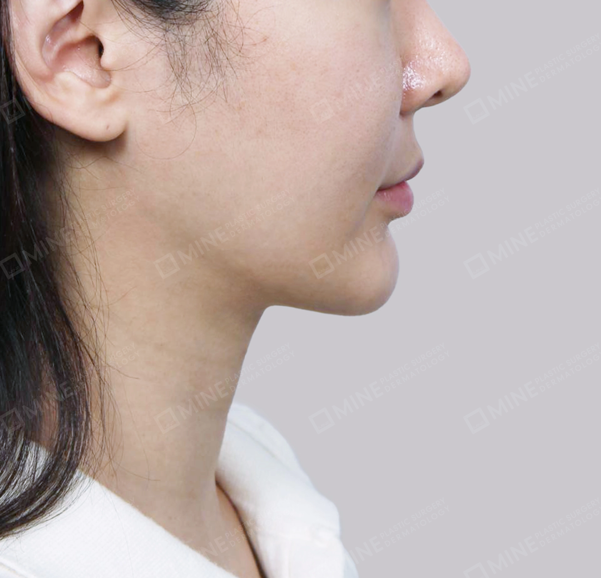 Hút mỡ nọng, cắt tuyến nước bọt-정면-후