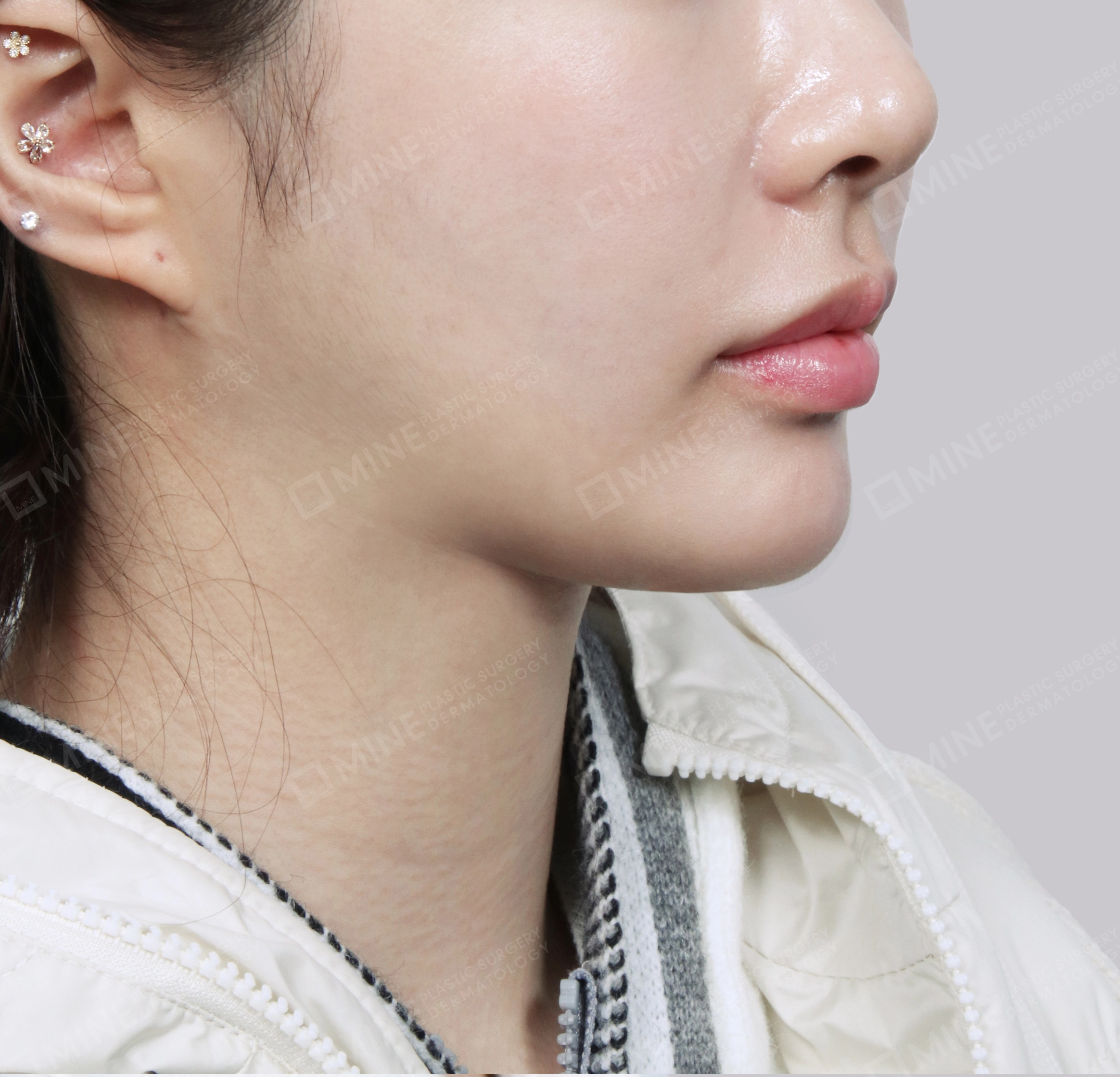 Hút mỡ nọng, cắt tuyến nước bọt-정면-후