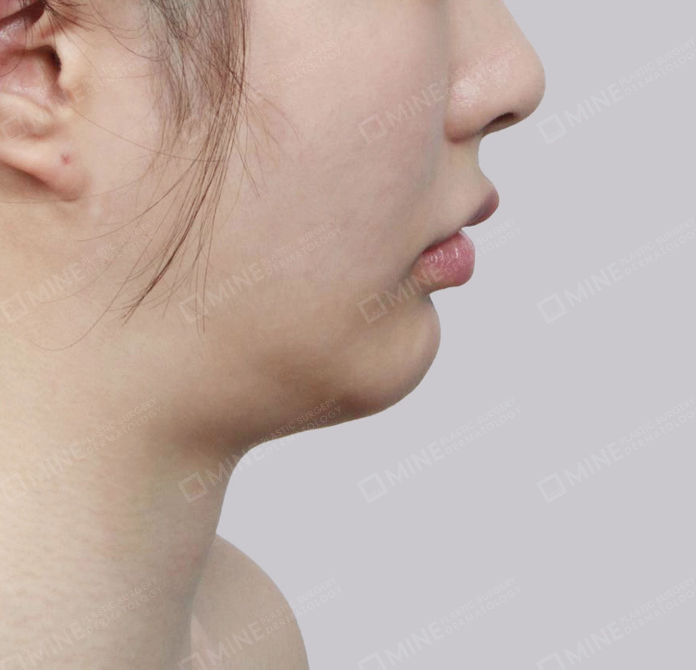 Hút mỡ nọng, cắt tuyến nước bọt-측면-전