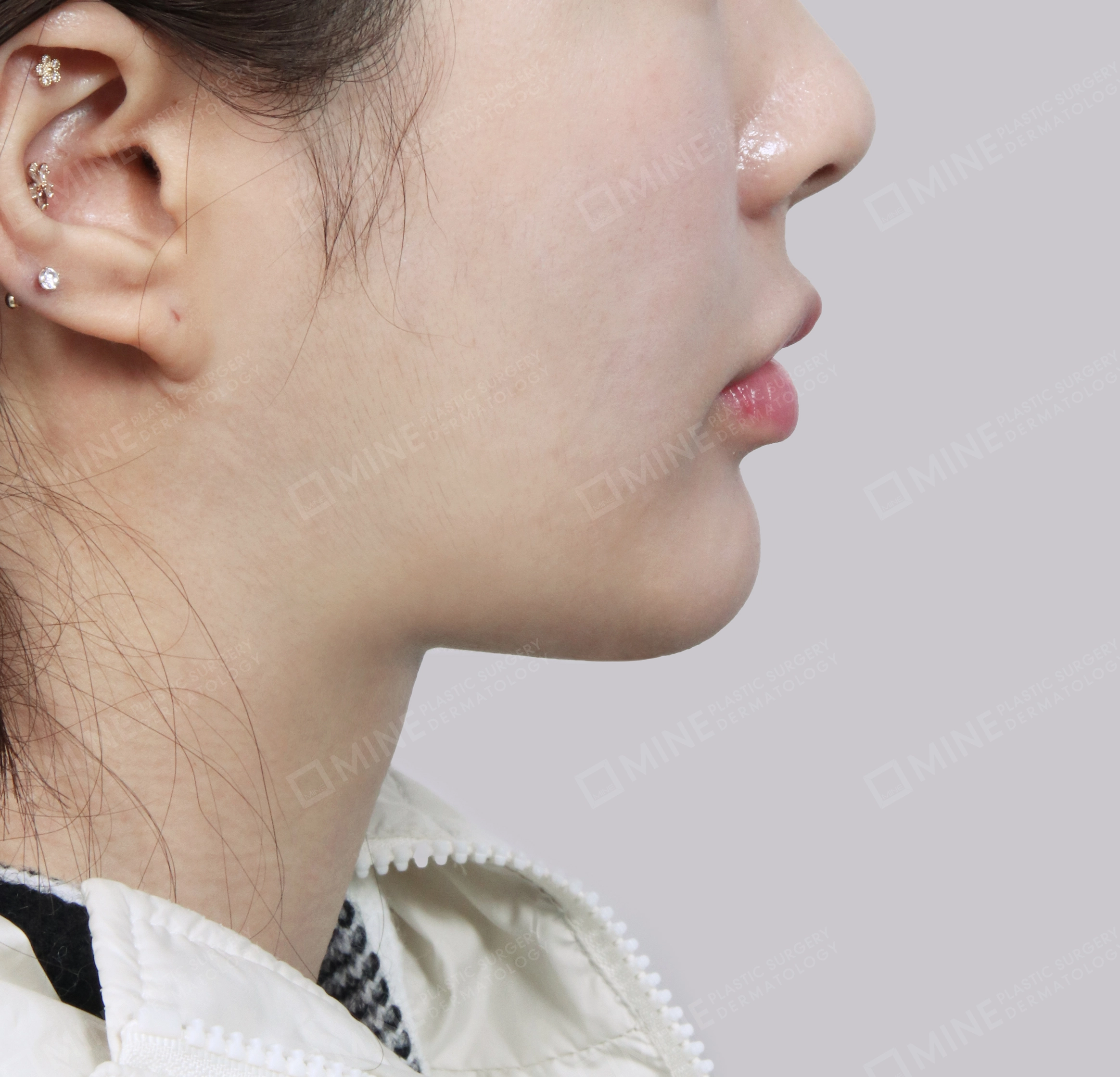 Hút mỡ nọng, cắt tuyến nước bọt-측면-후