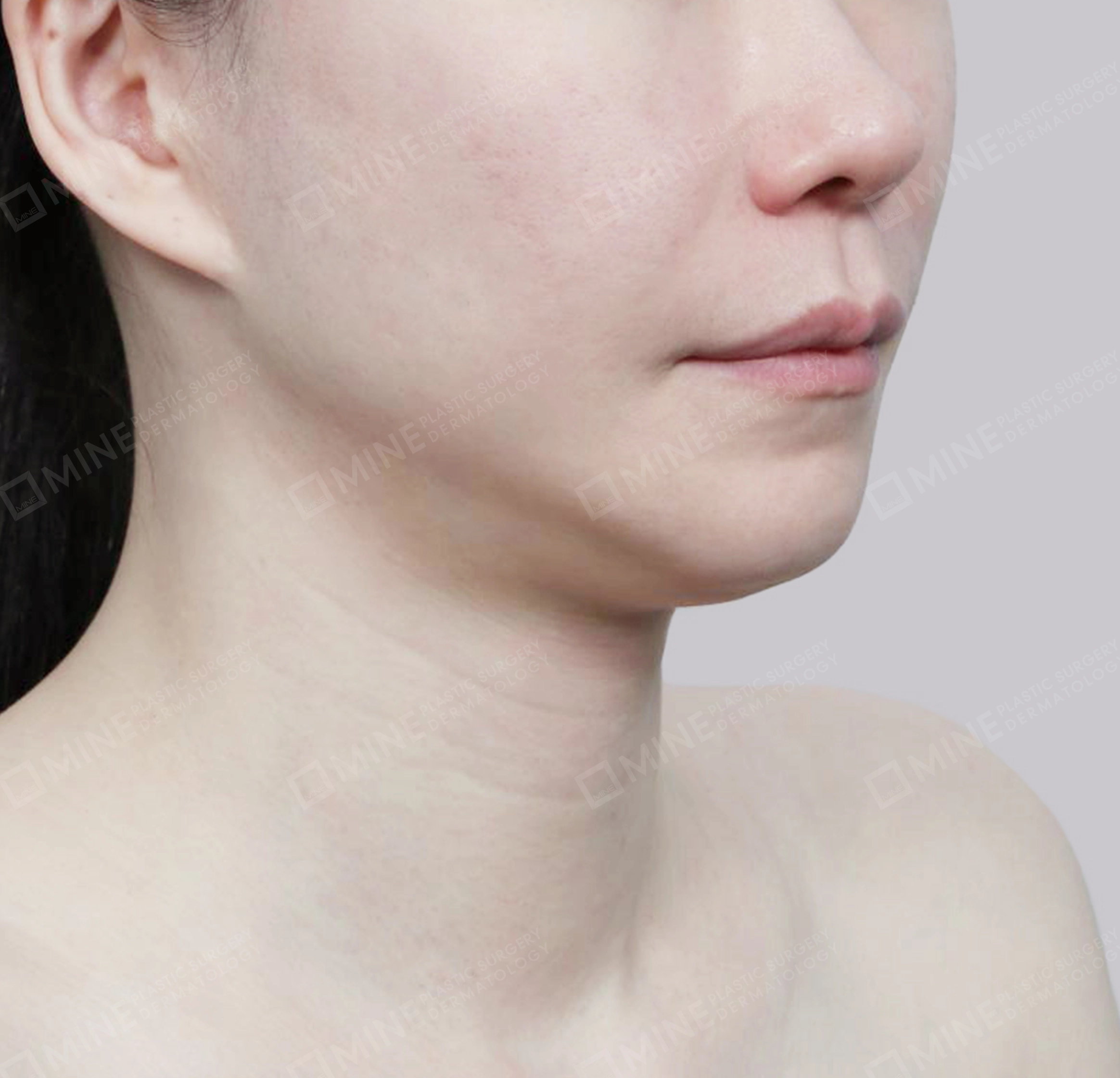 Hút mỡ nọng, cắt tuyến nước bọt-정면-전