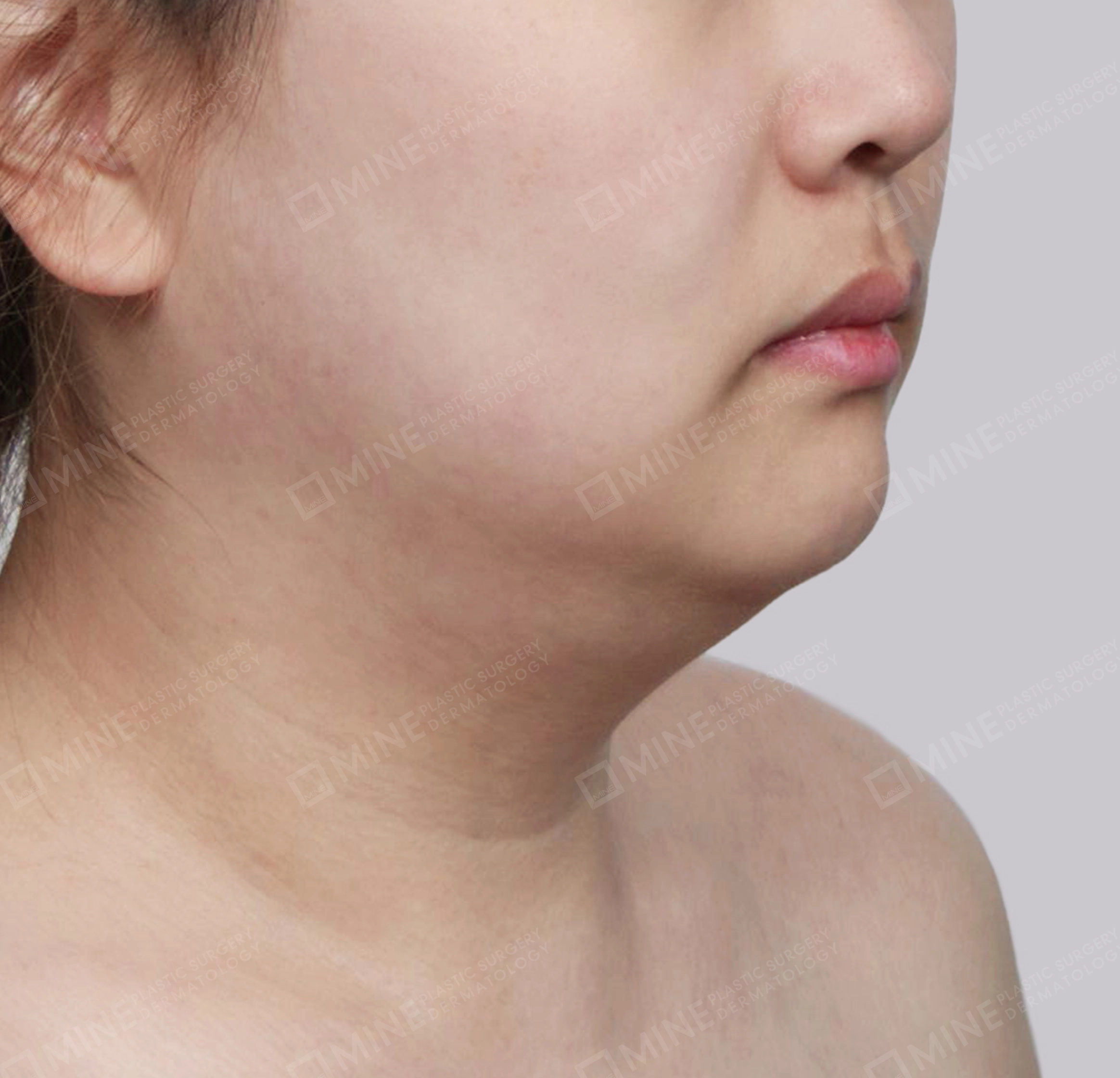 Hút mỡ nọng, cắt tuyến nước bọt-정면-전