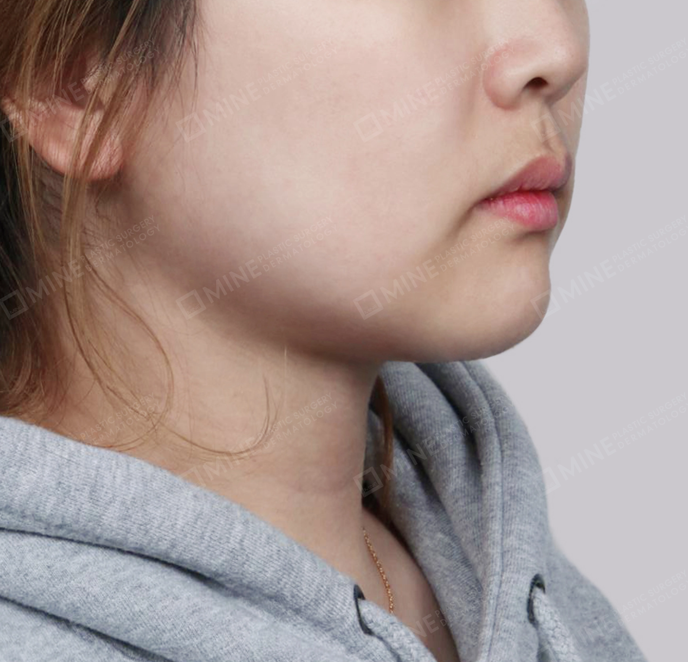 Hút mỡ nọng, cắt tuyến nước bọt-정면-후