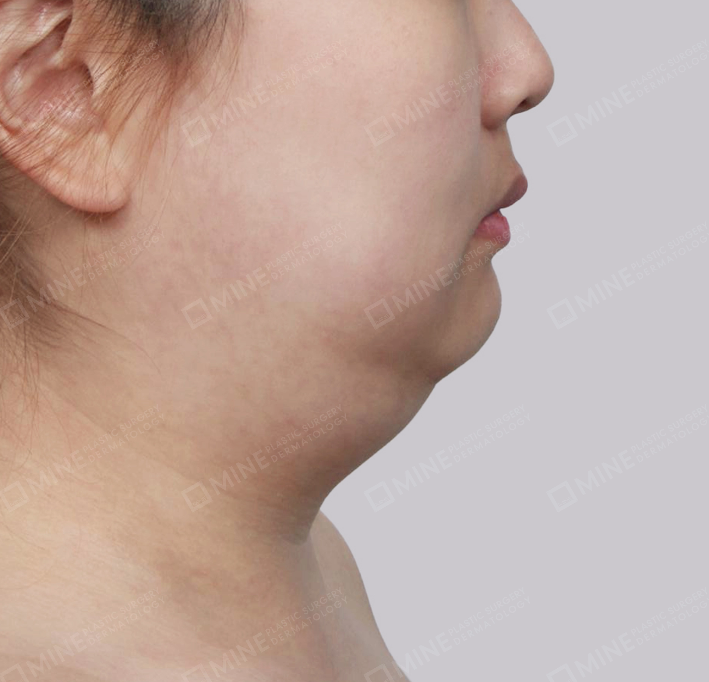 Hút mỡ nọng, cắt tuyến nước bọt-측면-전