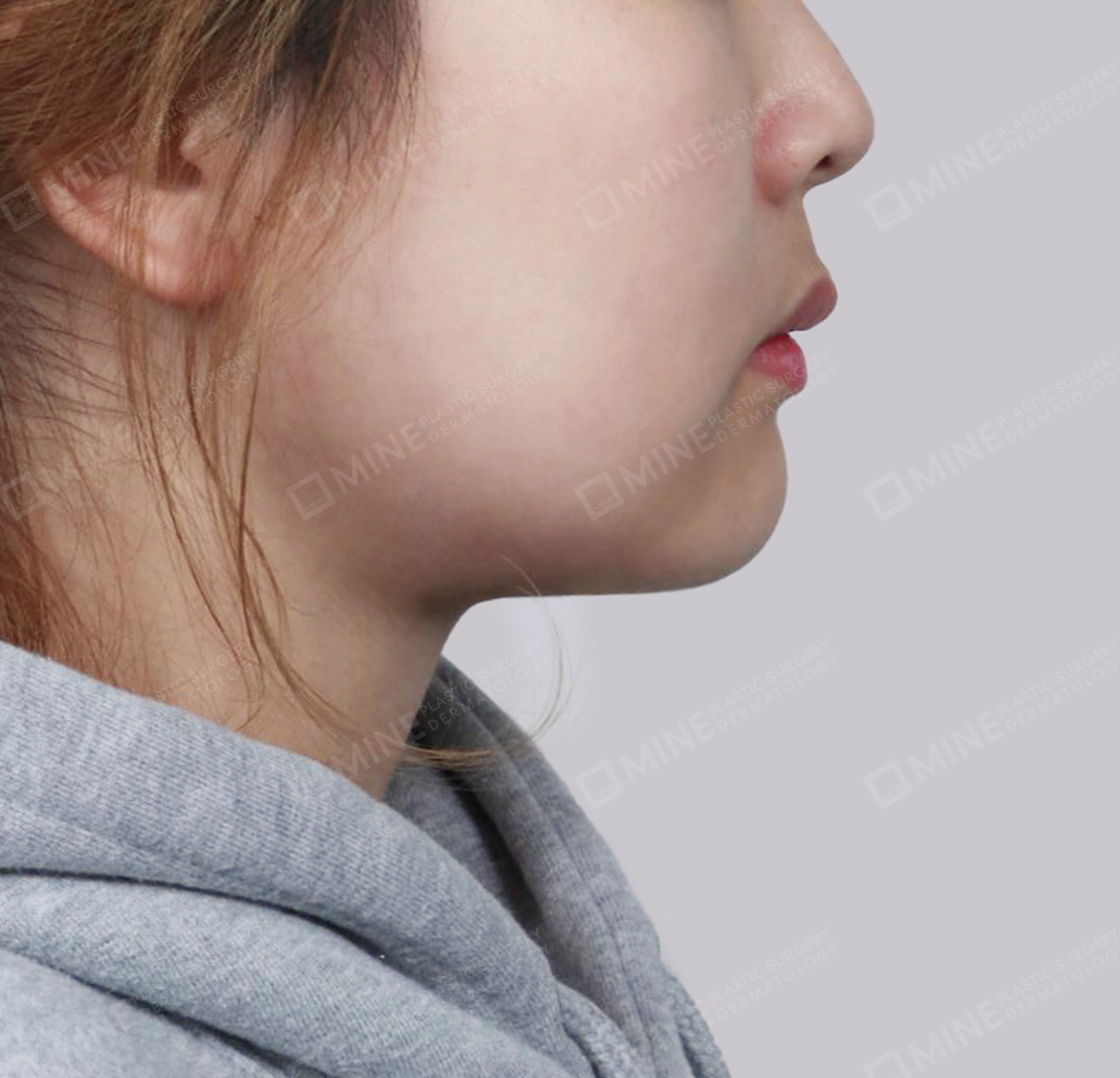 Hút mỡ nọng, cắt tuyến nước bọt-측면-후