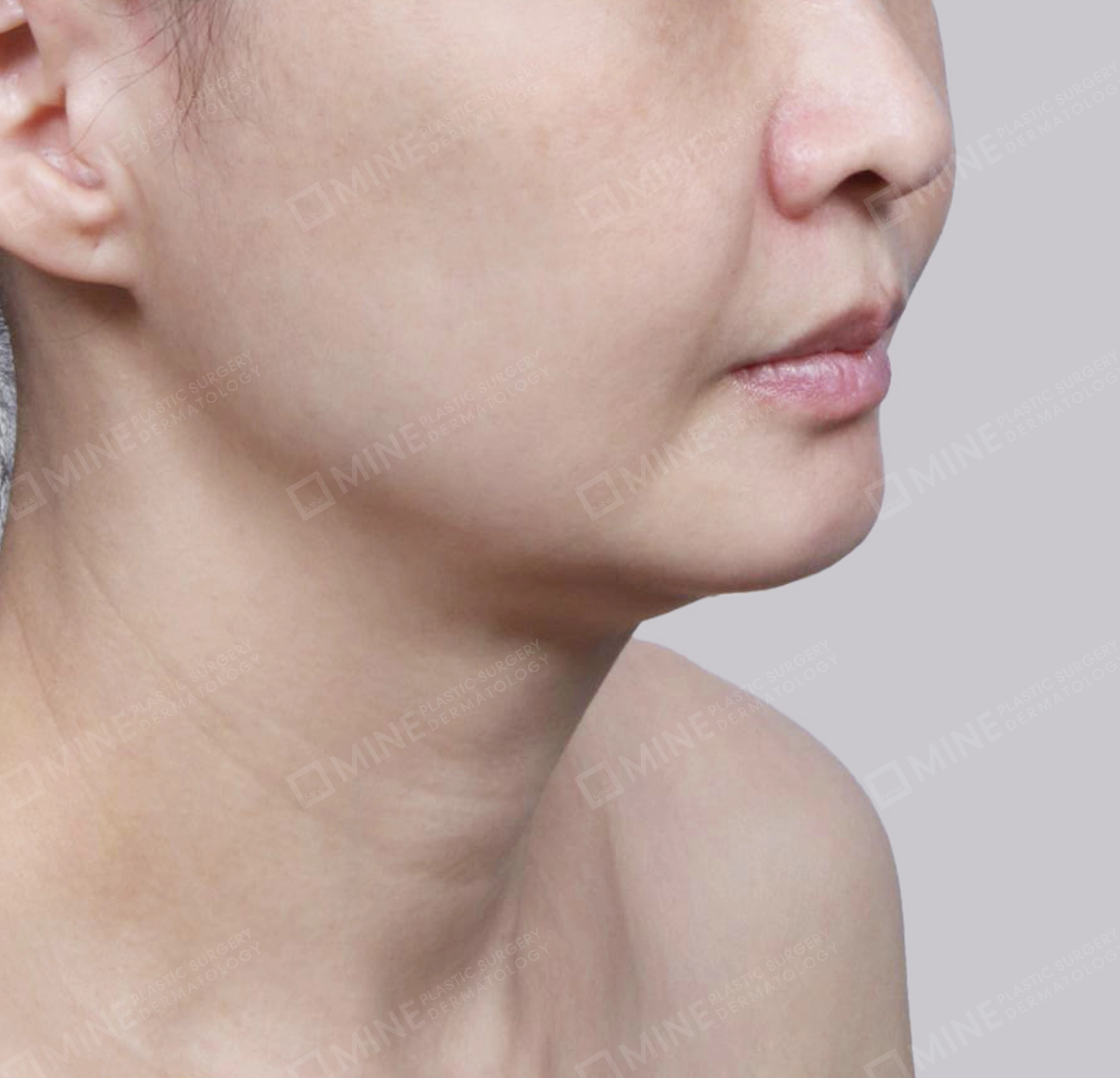 Hút mỡ nọng, cắt tuyến nước bọt-정면-전