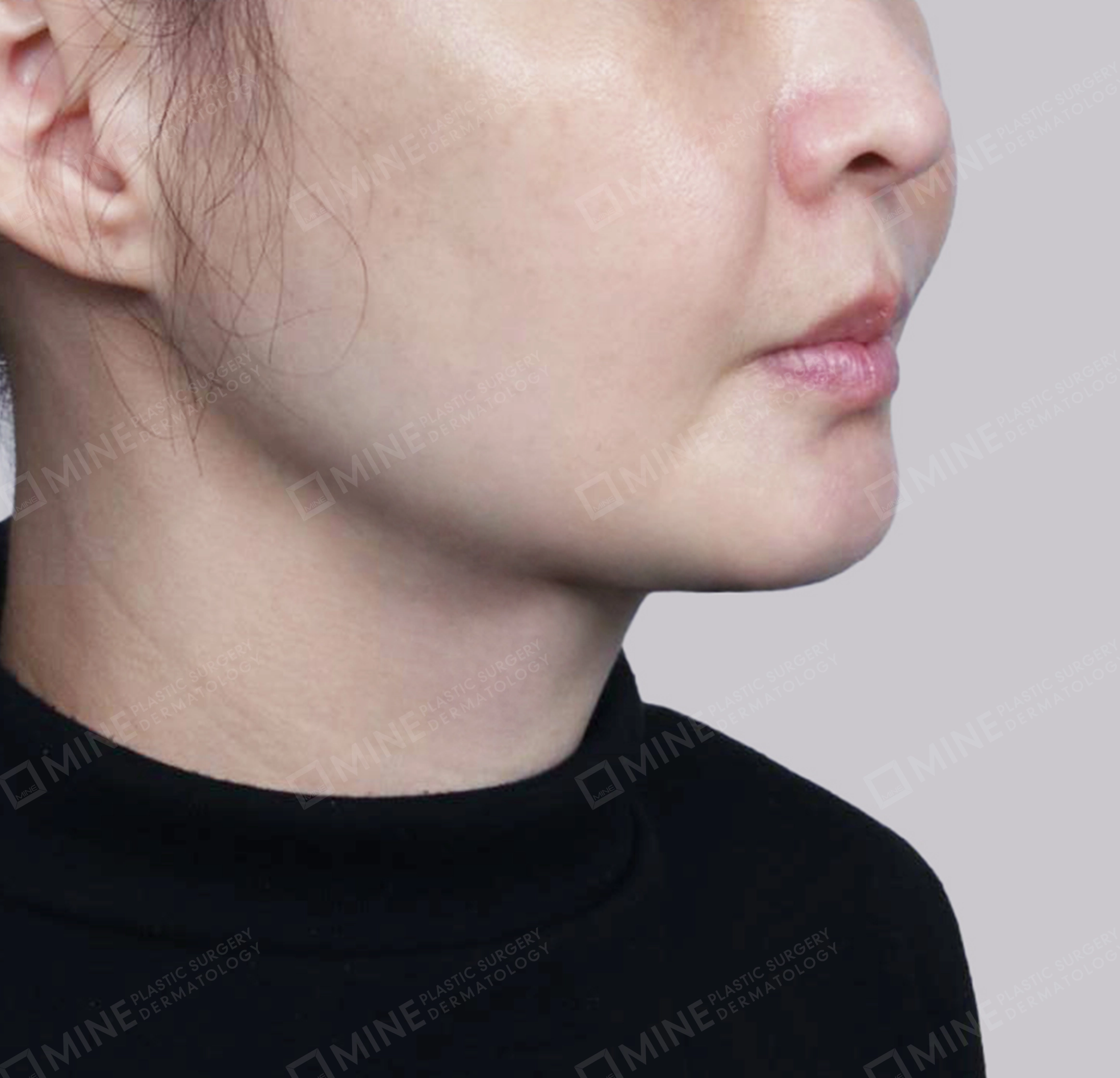 Hút mỡ nọng, cắt tuyến nước bọt-정면-후