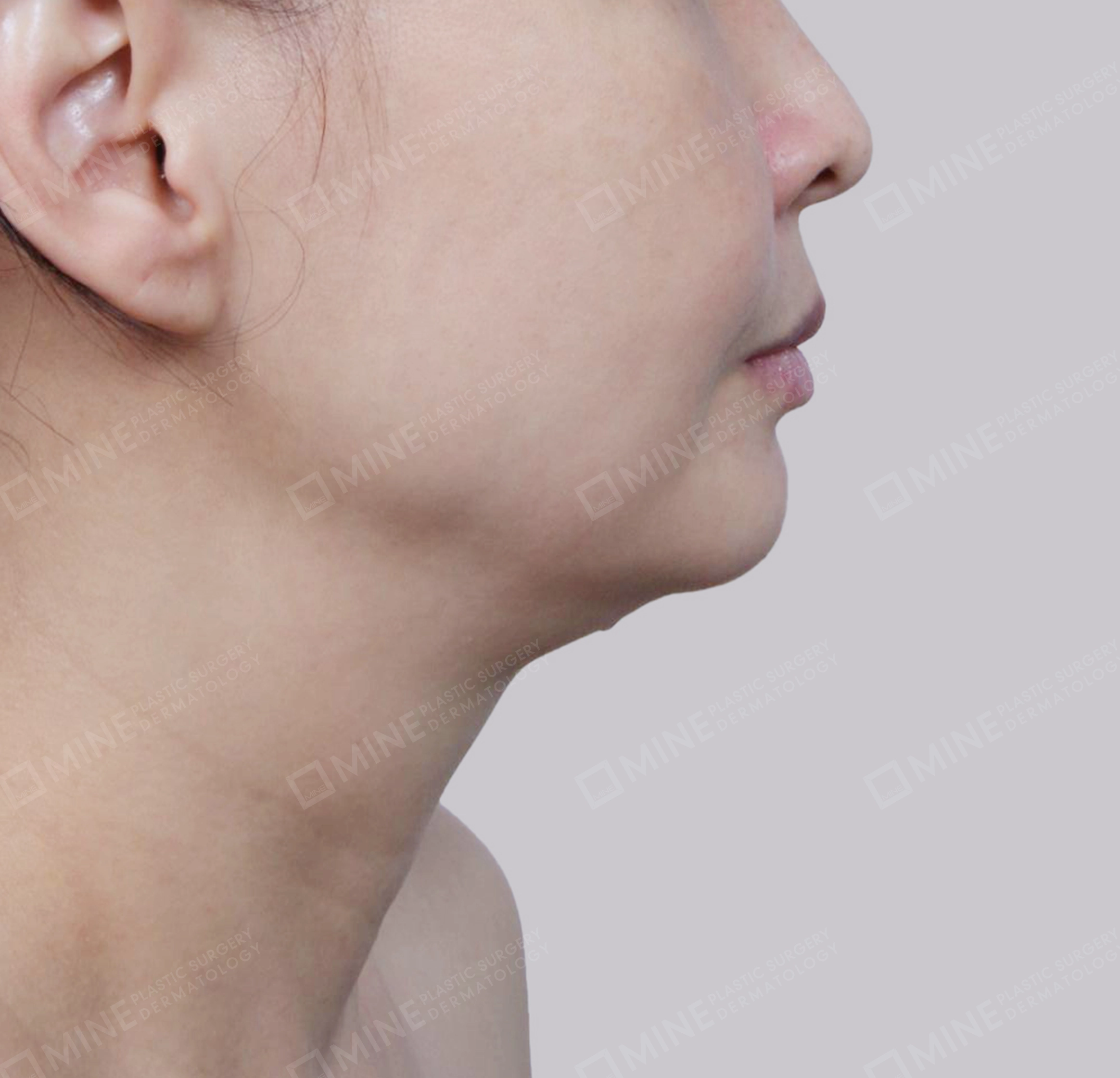 Hút mỡ nọng, cắt tuyến nước bọt-측면-전