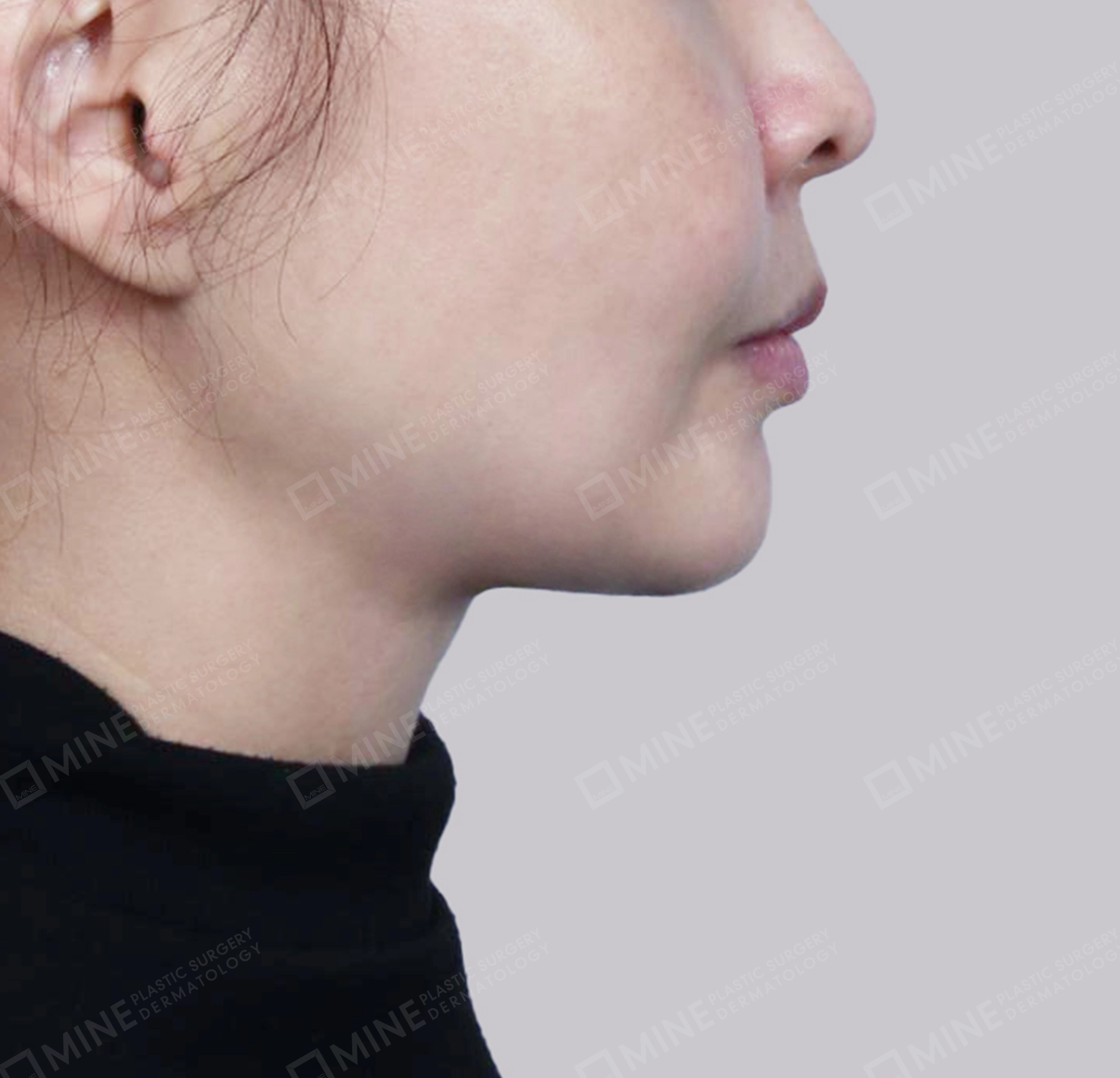 Hút mỡ nọng, cắt tuyến nước bọt-측면-후