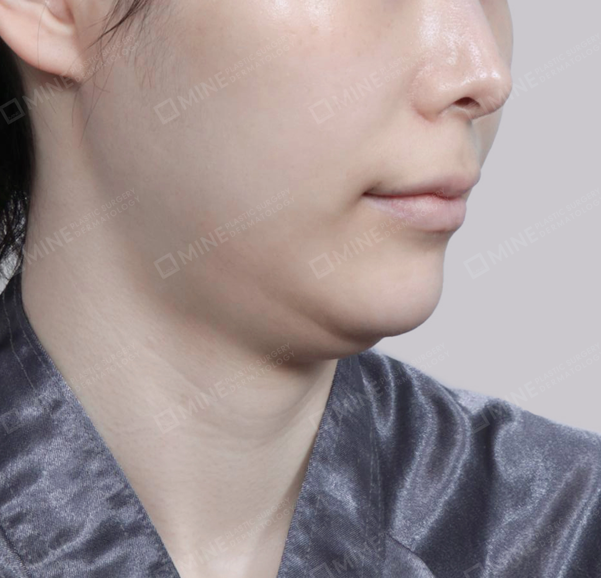 Hút mỡ nọng, cắt tuyến nước bọt-정면-전