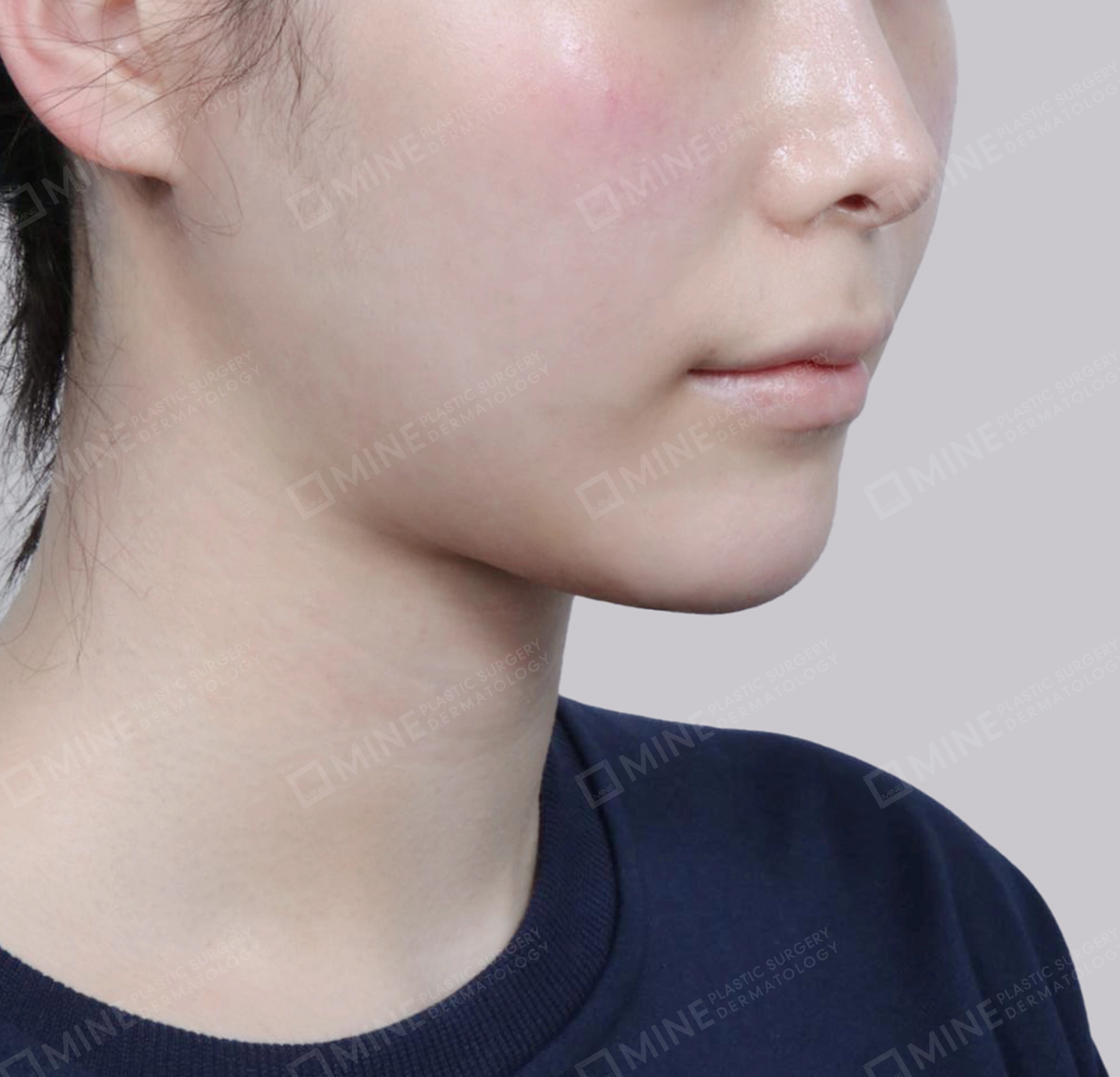 Hút mỡ nọng, cắt tuyến nước bọt-정면-후