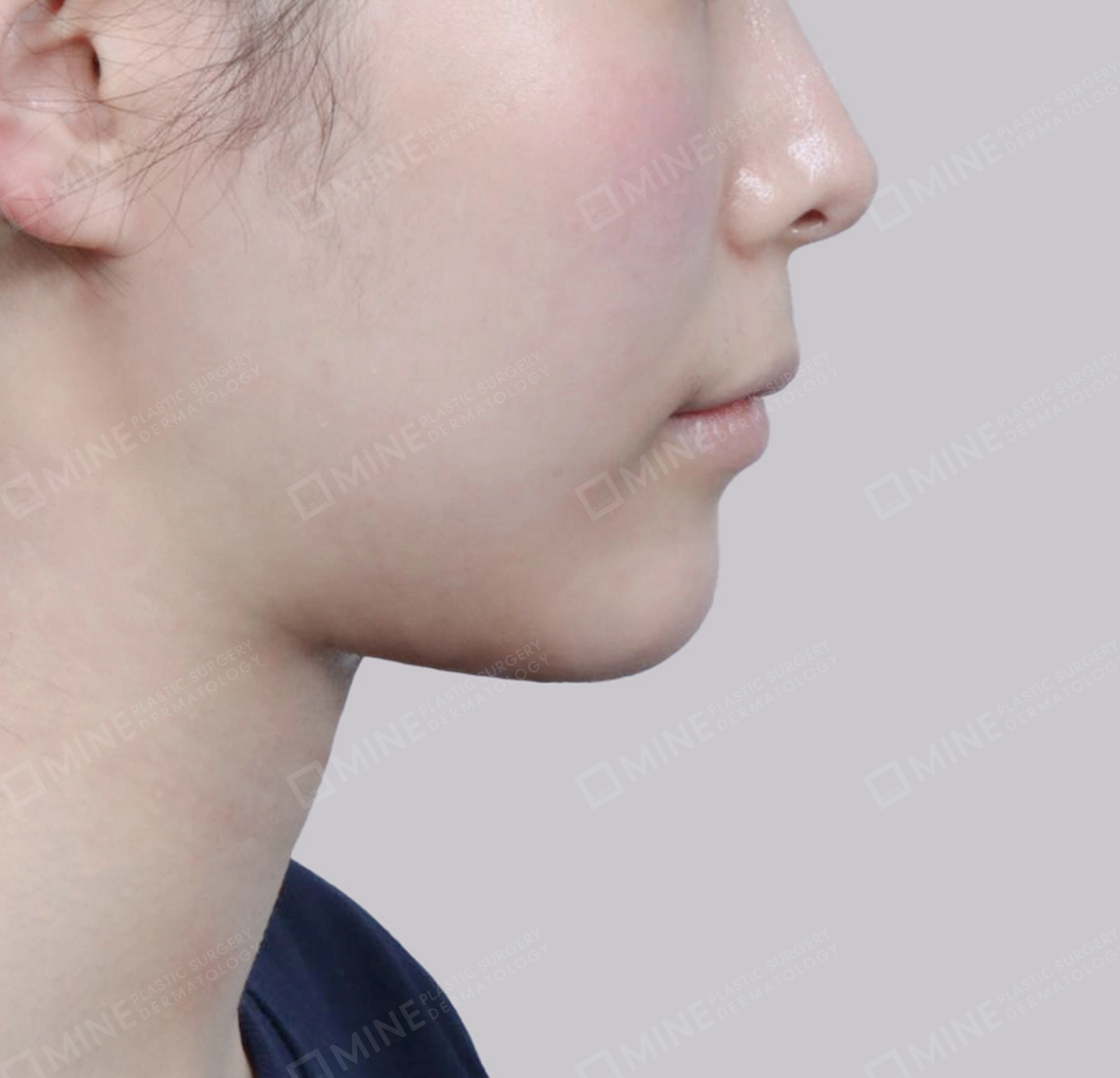 Hút mỡ nọng, cắt tuyến nước bọt-측면-후