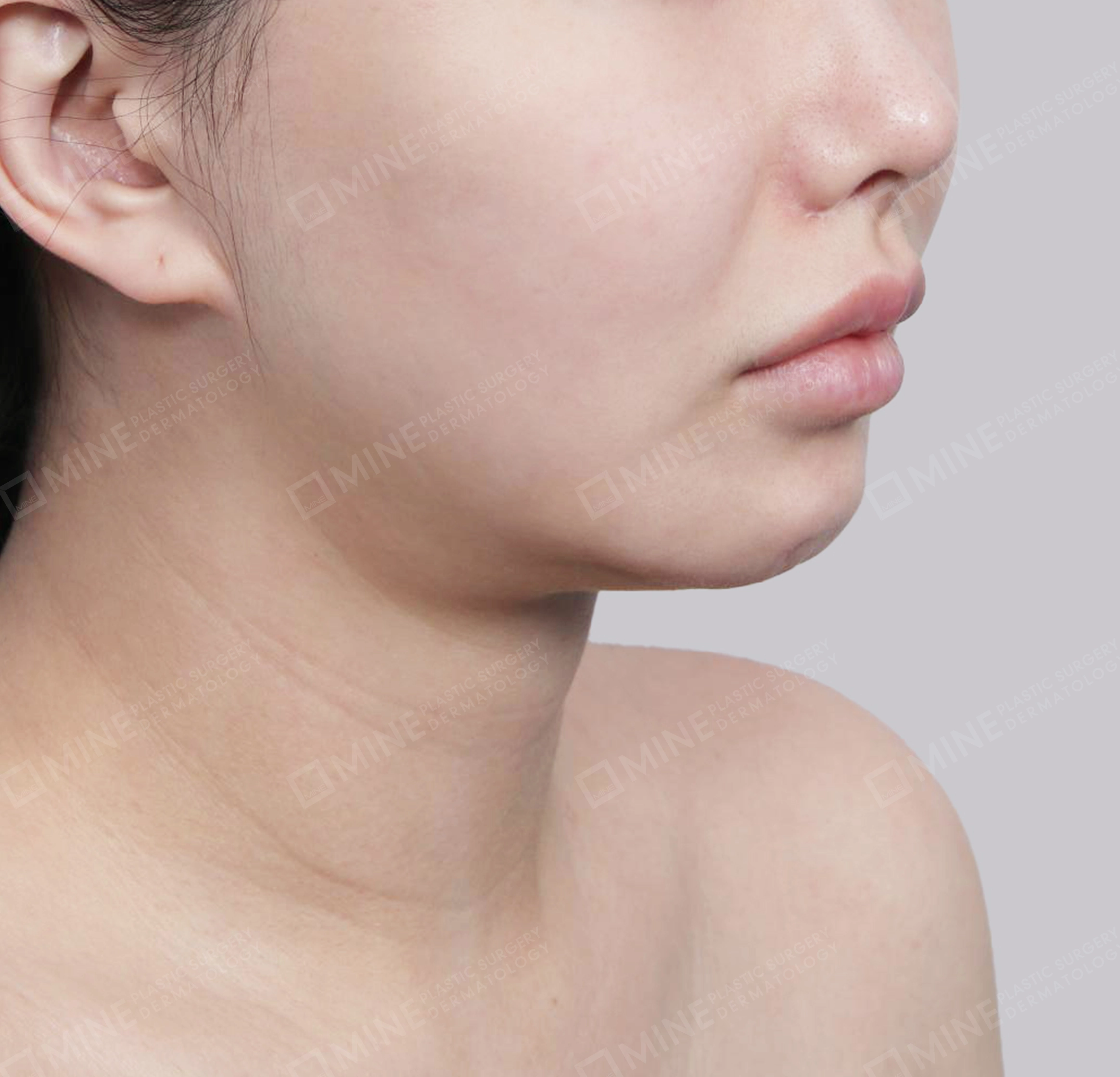 Hút mỡ nọng, cắt tuyến nước bọt-정면-전