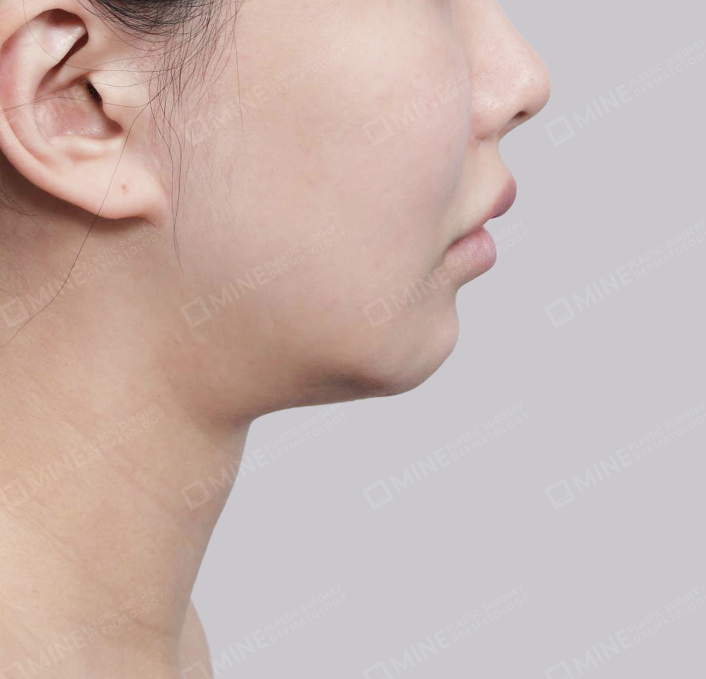 Hút mỡ nọng, cắt tuyến nước bọt-측면-전