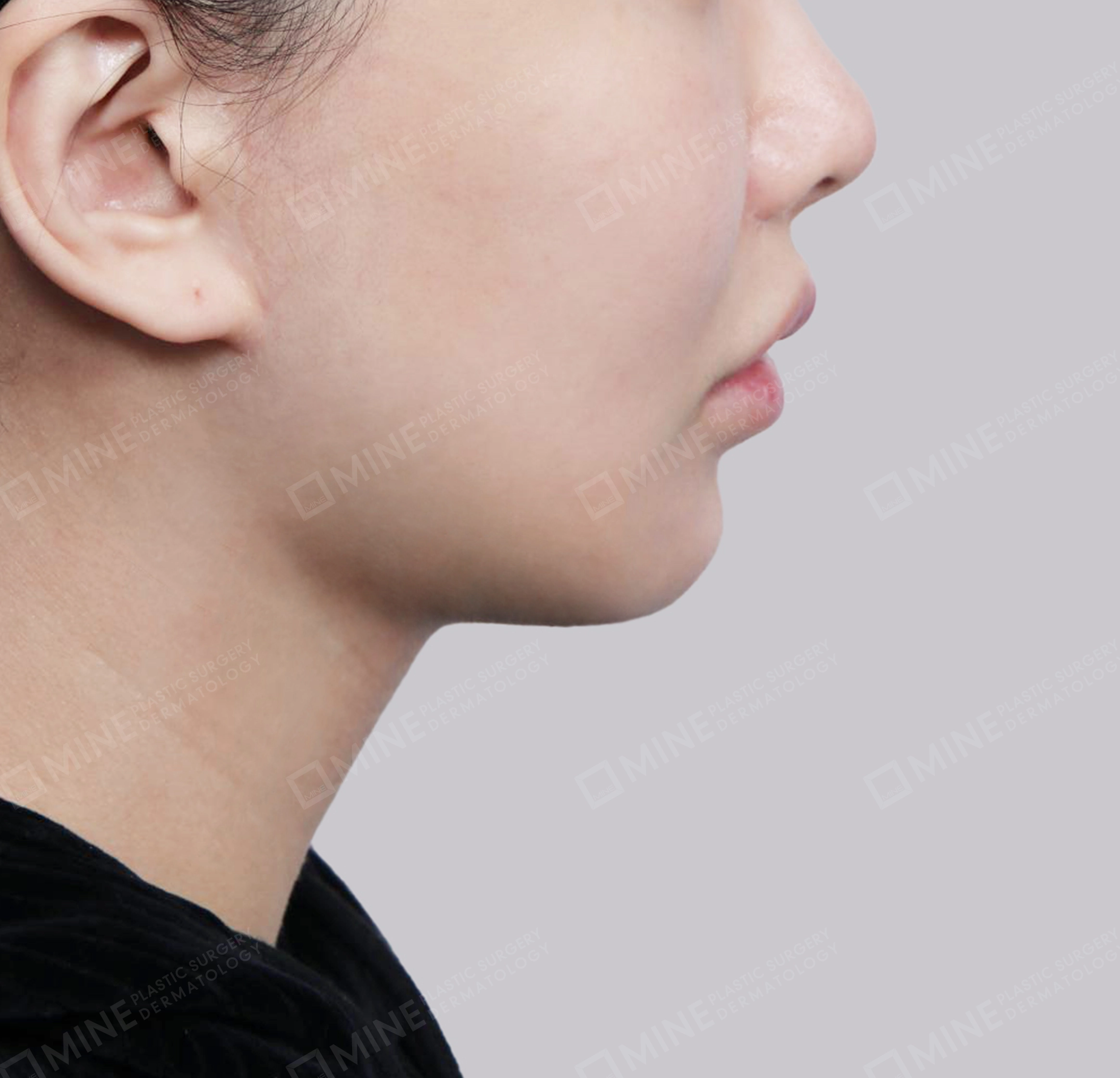 Hút mỡ nọng, cắt tuyến nước bọt-측면-후