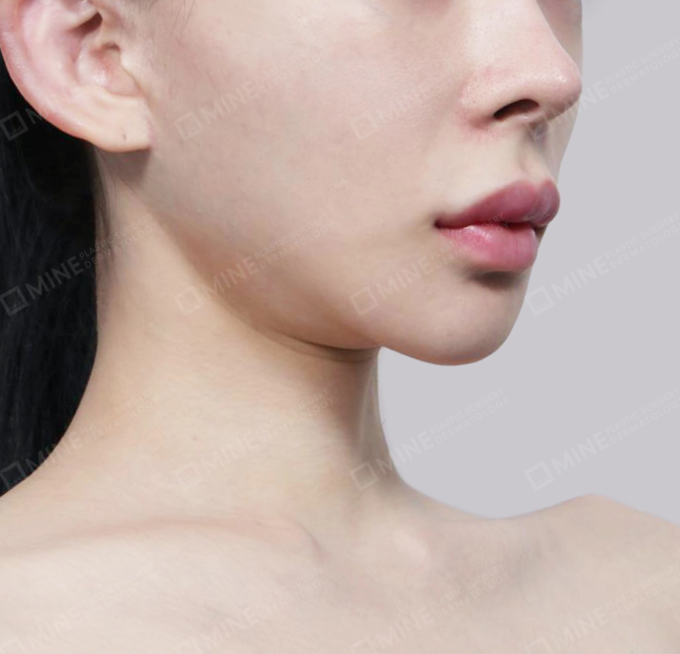 Hút mỡ nọng, cắt tuyến nước bọt-정면-전