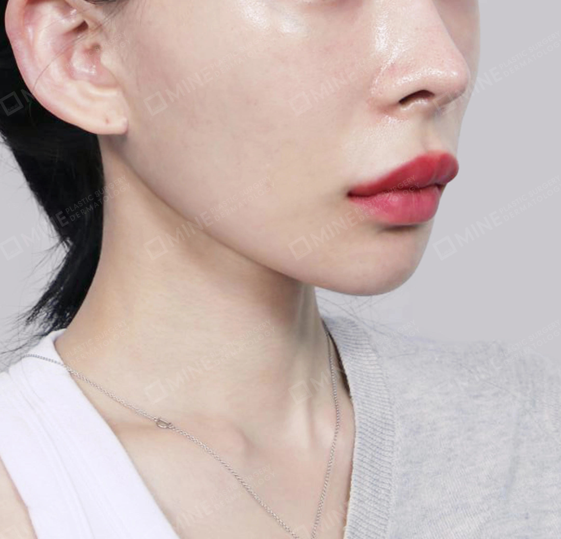 Hút mỡ nọng, cắt tuyến nước bọt-정면-후