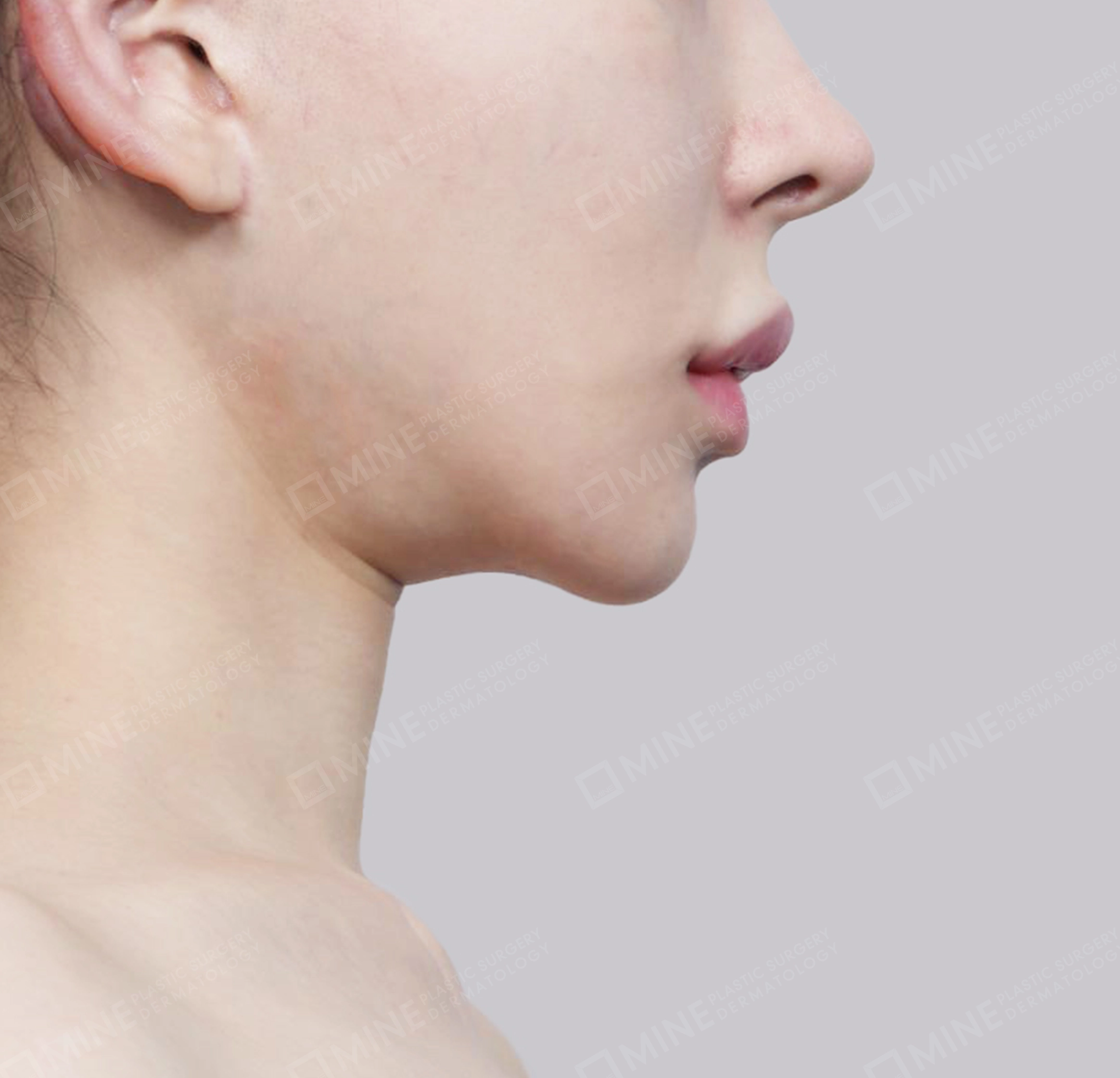 Hút mỡ nọng, cắt tuyến nước bọt-측면-전