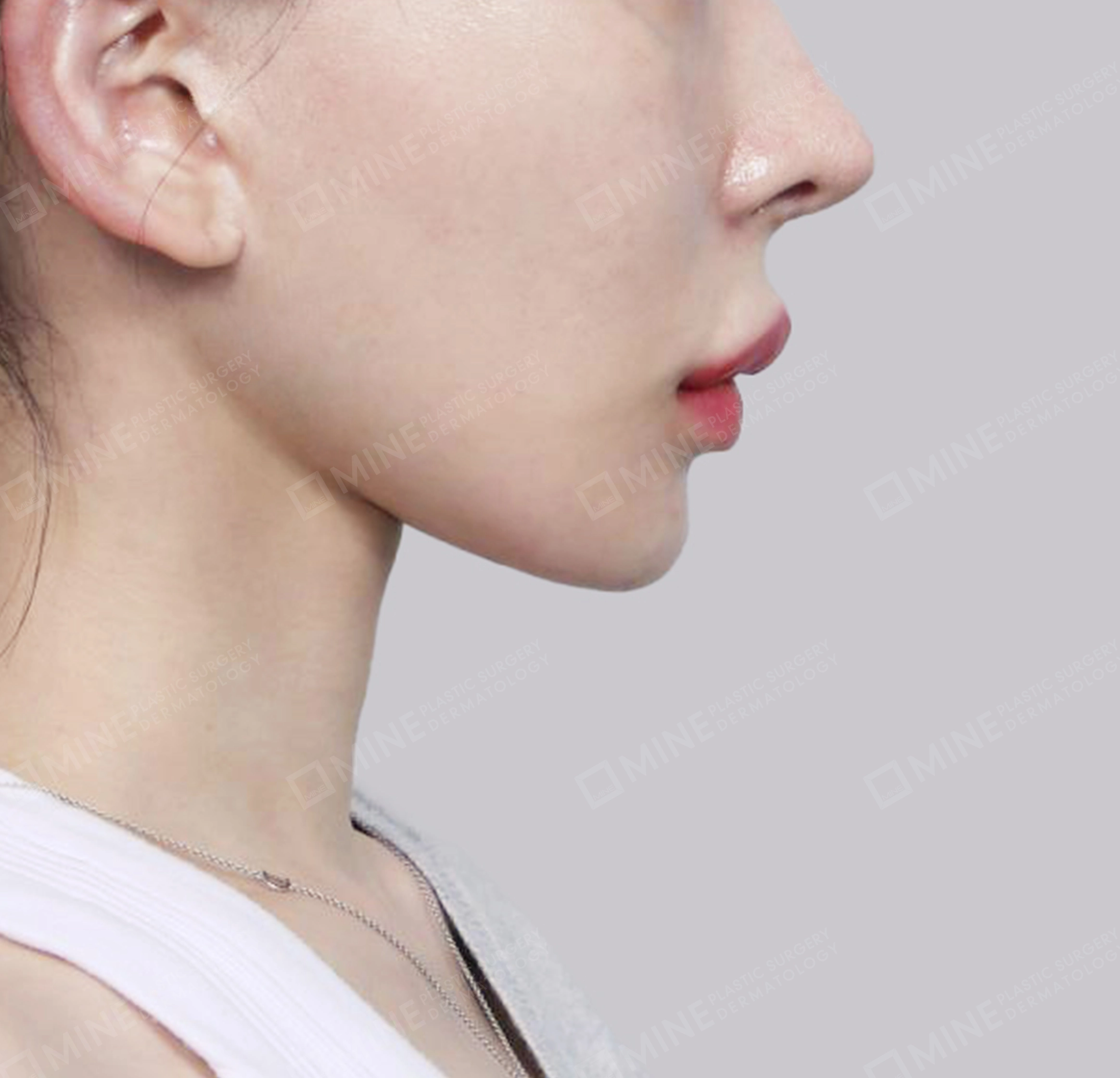 Hút mỡ nọng, cắt tuyến nước bọt-측면-후