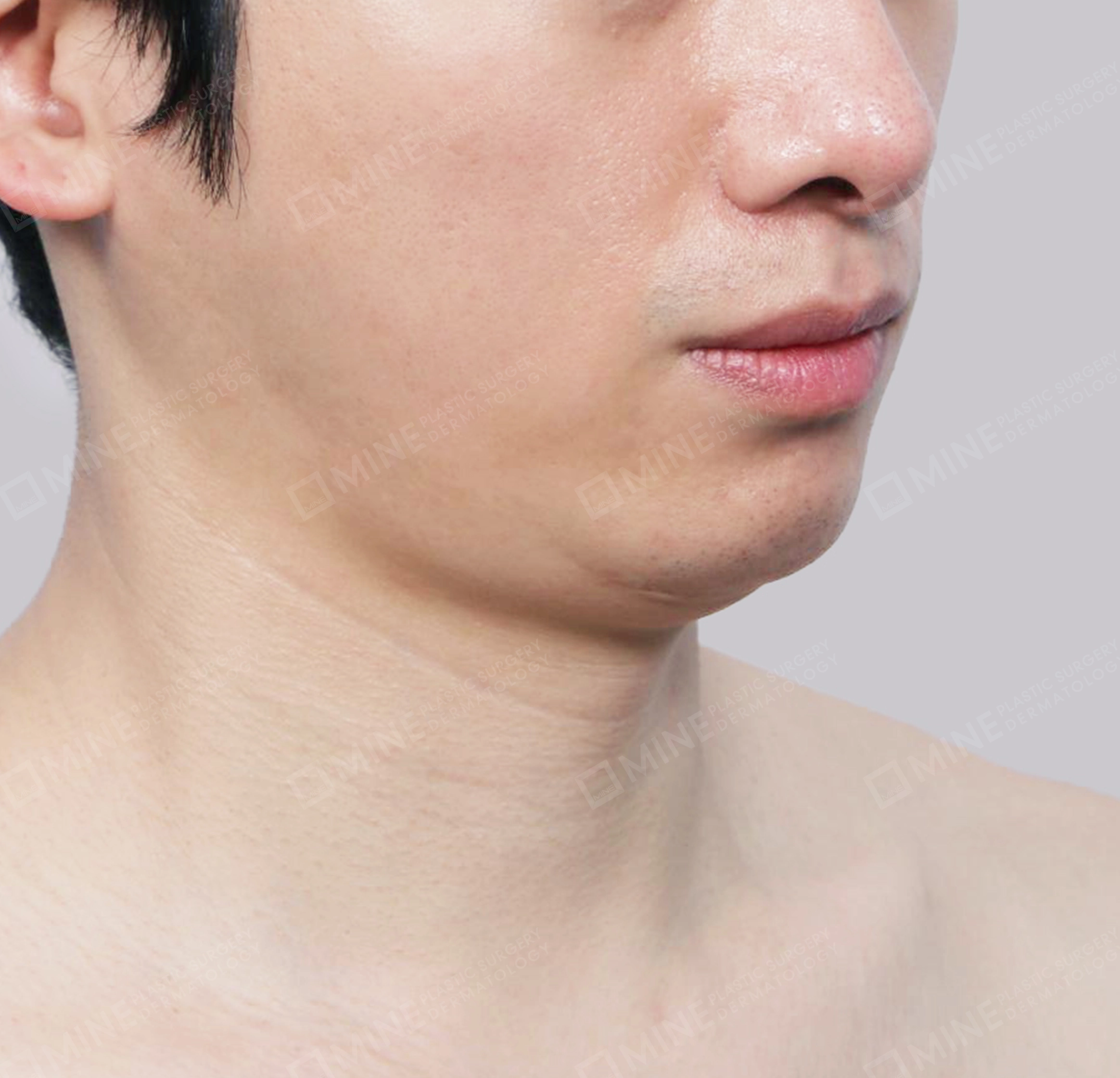 Hút mỡ nọng, cắt tuyến nước bọt-정면-전