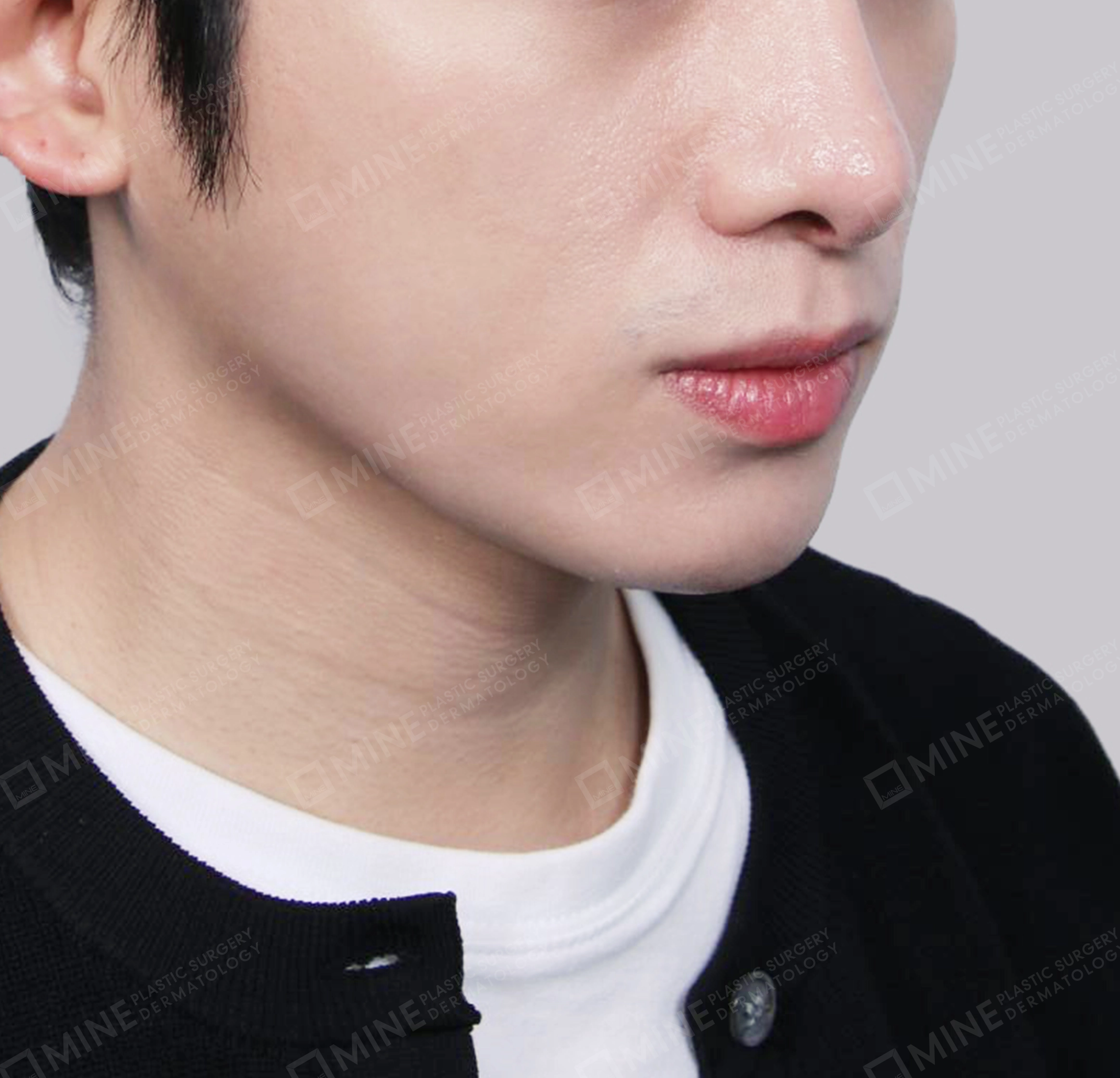 Hút mỡ nọng, cắt tuyến nước bọt-정면-후