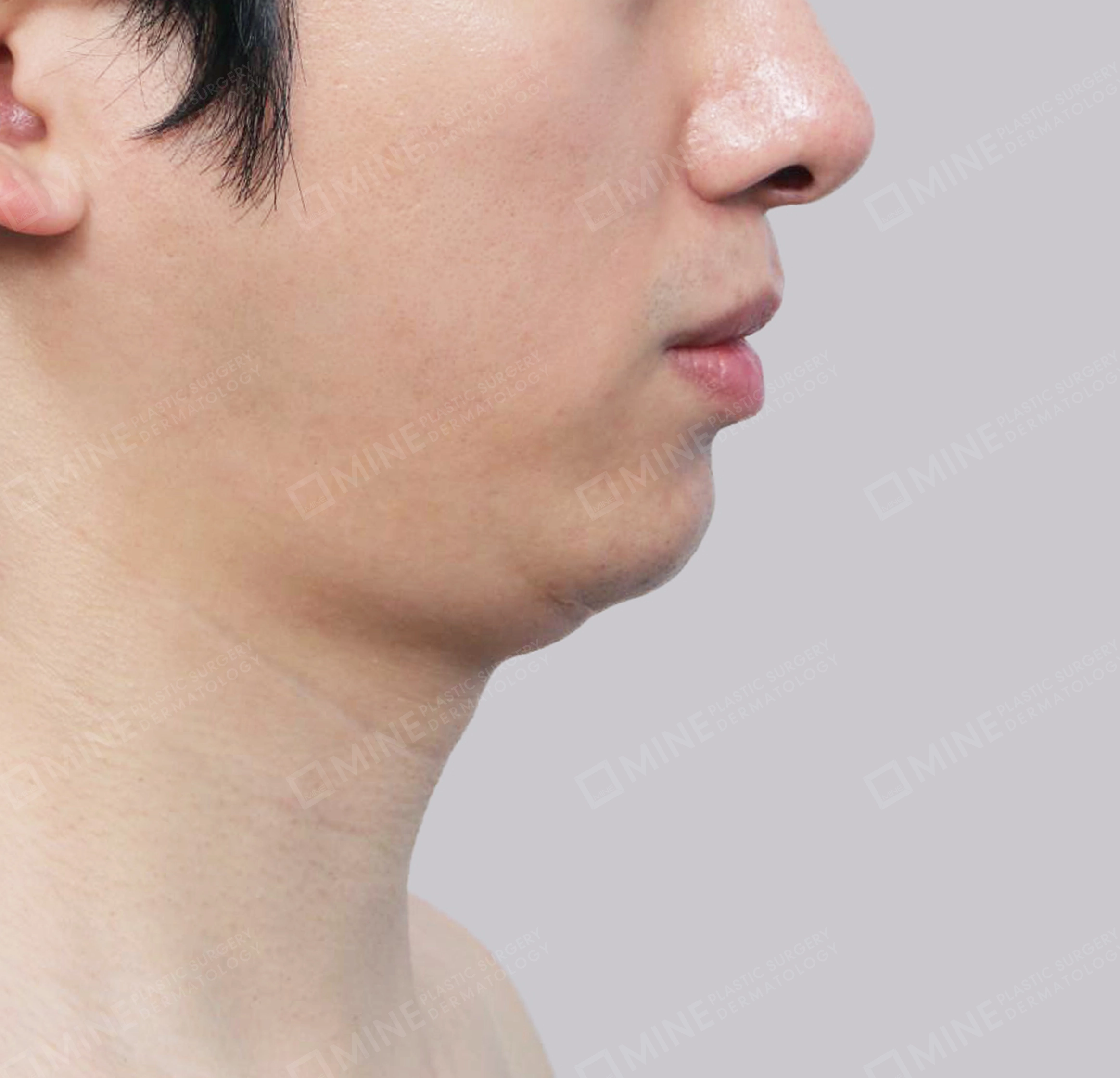 Hút mỡ nọng, cắt tuyến nước bọt-측면-전