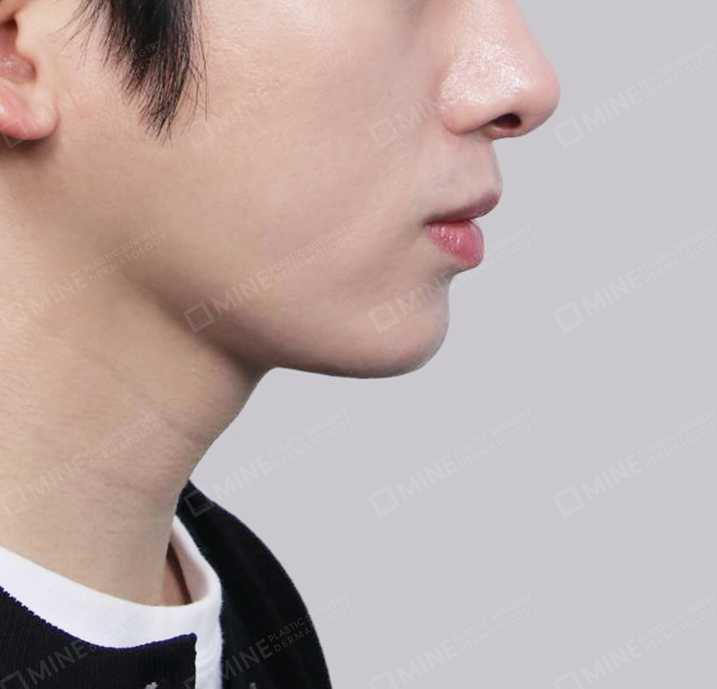 Hút mỡ nọng, cắt tuyến nước bọt-측면-후